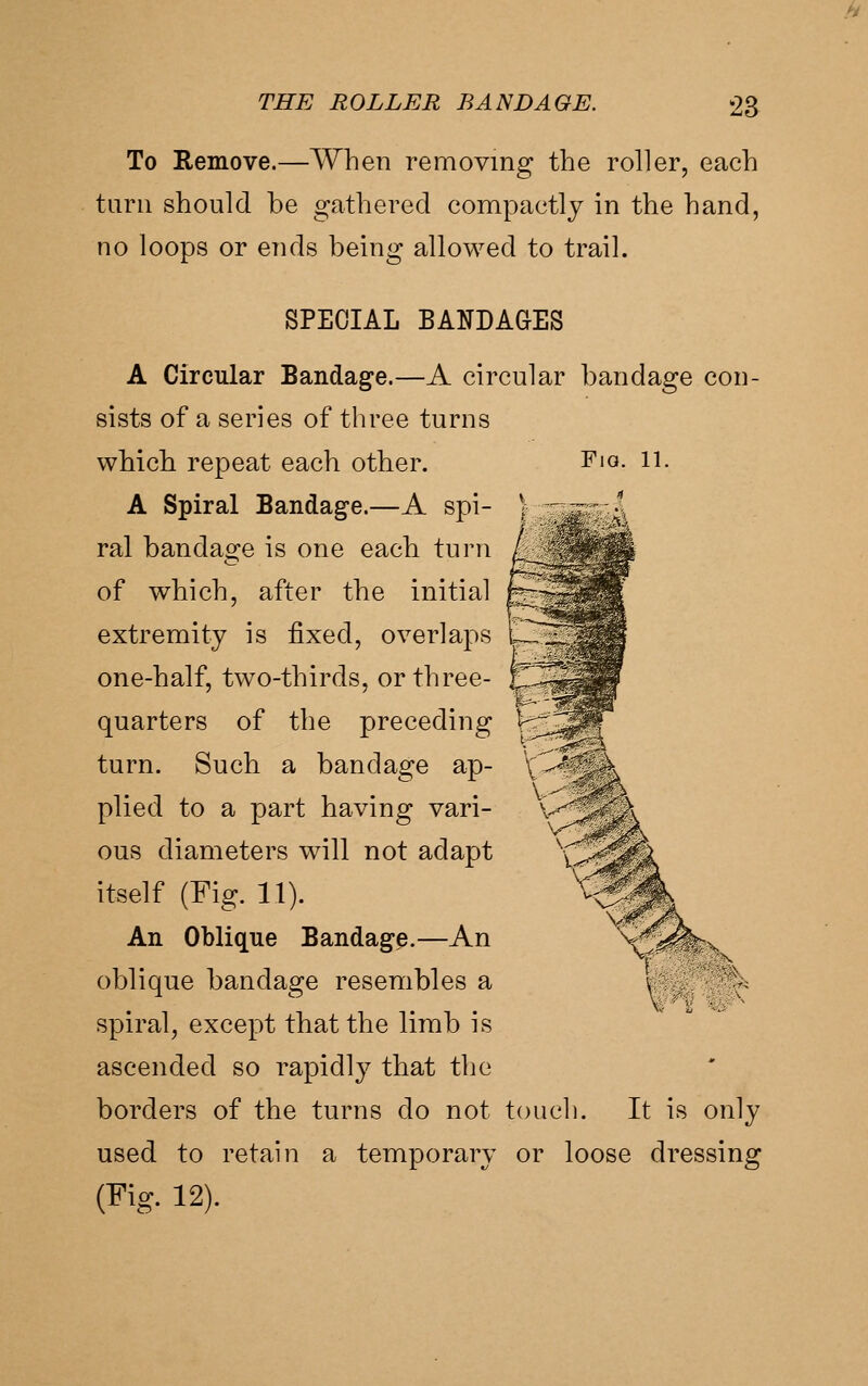 h THE ROLLER BANDAGE. 2a To Remove.—When removing the roller, each turn should be gathered compactly in the hand, no loops or ends being allowed to trail. SPECIAL BANDAGES A Circular Bandage.—A circular bandage con- sists of a series of three turns which repeat each other. Fia. ii. A Spiral Bandage.—A spi- ral bandage is one each turn of which, after the initial extremity is fixed, overlaps one-half, two-thirds, or three- quarters of the preceding turn. Such a bandage ap- plied to a part having vari- ous diameters will not adapt itself (Fig. 11). An Oblique Bandage.—An oblique bandage resembles a spiral, except that the limb is ascended so rapidly that the borders of the turns do not touch. It is only used to retain a tenaporary or loose dressing (Fig. 12).