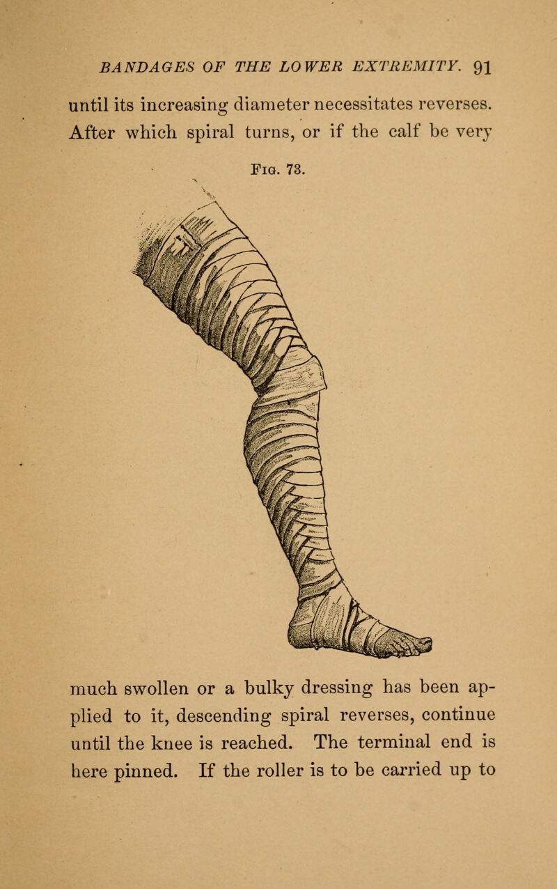 until its increasing diameter necessitates reverses. After which spiral turns, or if the calf be very Fig. 73. much swollen or a bulky dressing has been ap- plied to it, descending spiral reverses, continue until the knee is reached. The terminal end is here pinned. If the roller is to be carried up to