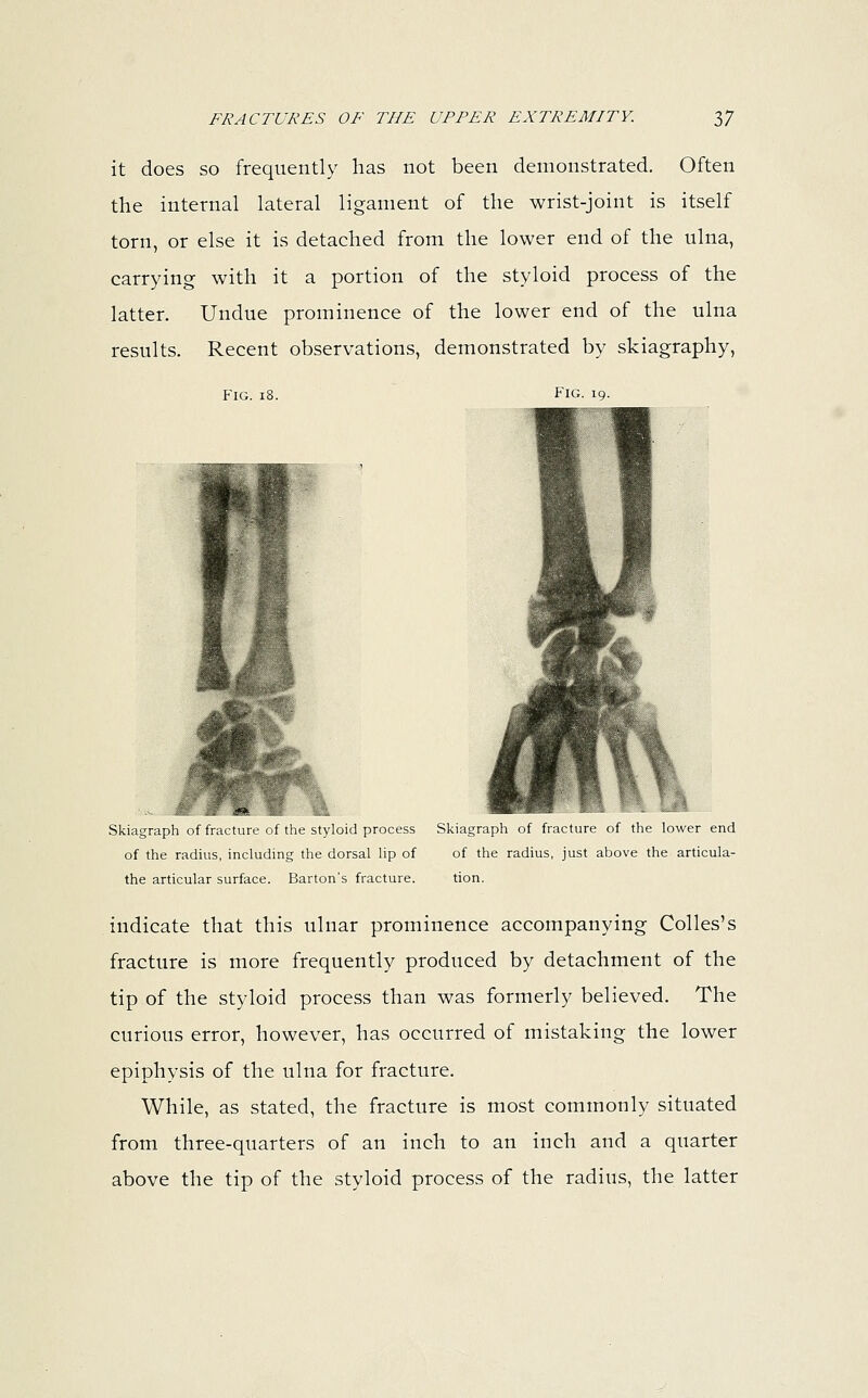 it does so frequently has not been demonstrated. Often the internal lateral ligament of the wrist-joint is itself torn, or else it is detached from the lower end of the ulna, carrying with it a portion of the styloid process of the latter. Undue prominence of the lower end of the ulna results. Recent observations, demonstrated by skiagraphy, Fig. 18. Fig. 19. Skiagraph of fracture of the styloid process Skiagraph of fracture of the lower end of the radius, including the dorsal lip of of the radius, just above the articula- ble articular surface. Barton's fracture. tion. indicate that this ulnar prominence accompanying Colles's fracture is more frequently produced by detachment of the tip of the styloid process than was formerly believed. The curious error, however, has occurred of mistaking the lower epiphysis of the ulna for fracture. While, as stated, the fracture is most commonly situated from three-quarters of an inch to an inch and a quarter above the tip of the styloid process of the radius, the latter