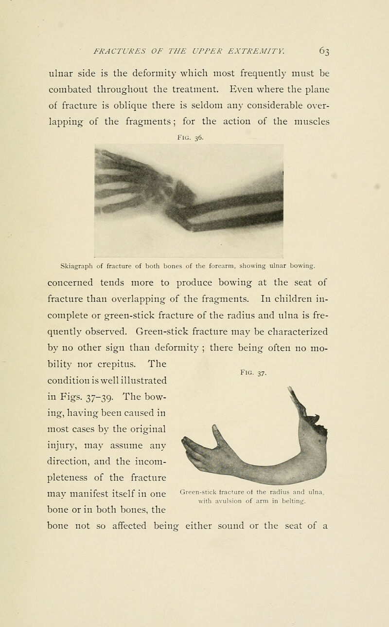 ulnar side is the deformity which most frequently must be combated throughout the treatment. Even where the plane of fracture is oblique there is seldom any considerable over- lapping of the fragments; for the action of the muscles Fig. 36. Skiagraph of fracture of both bones of the forearm, showing ulnar bowing. concerned tends more to produce bowing at the seat of fracture than overlapping of the fragments. In children in- complete or green-stick fracture of the radius and ulna is fre- quently observed. Green-stick fracture may be characterized by no other sign than deformity ; there being often no mo- bility nor crepitus. The condition is well illustrated in Figs. 37-39. The bow- ing, having been caused in most cases bv the original Fig. 37. injury, may assume any direction, and the incom- pleteness of the fracture may manifest itself in One Green-stick fracture of the radius and ulna, with avulsion of arm in belting. bone or in both bones, the bone not so affected being- either sound or the seat of a