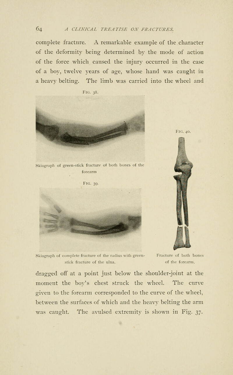 complete fracture. A remarkable example of the character of the deformity being determined by the mode of action of the force which caused the injury occurred in the case of a boy, twelve years of age, whose hand was caught in a heavy belting. The limb was carried into the wheel and Fig. 38. Fig. 40. Skiagraph of green-stick fracture of both bones of the forearm Fig. 39. Skiagraph of complete fracture of the radius with green- stick fracture of the ulna. Fracture of both bones of the forearm. dragged off at a point just below the shoulder-joint at the moment the boy's chest struck the wheel. The curve given to the forearm corresponded to the curve of the wheel, between the surfaces of which and the heavy belting the arm was caught. The avulsed extremity is shown in Fig. 37.