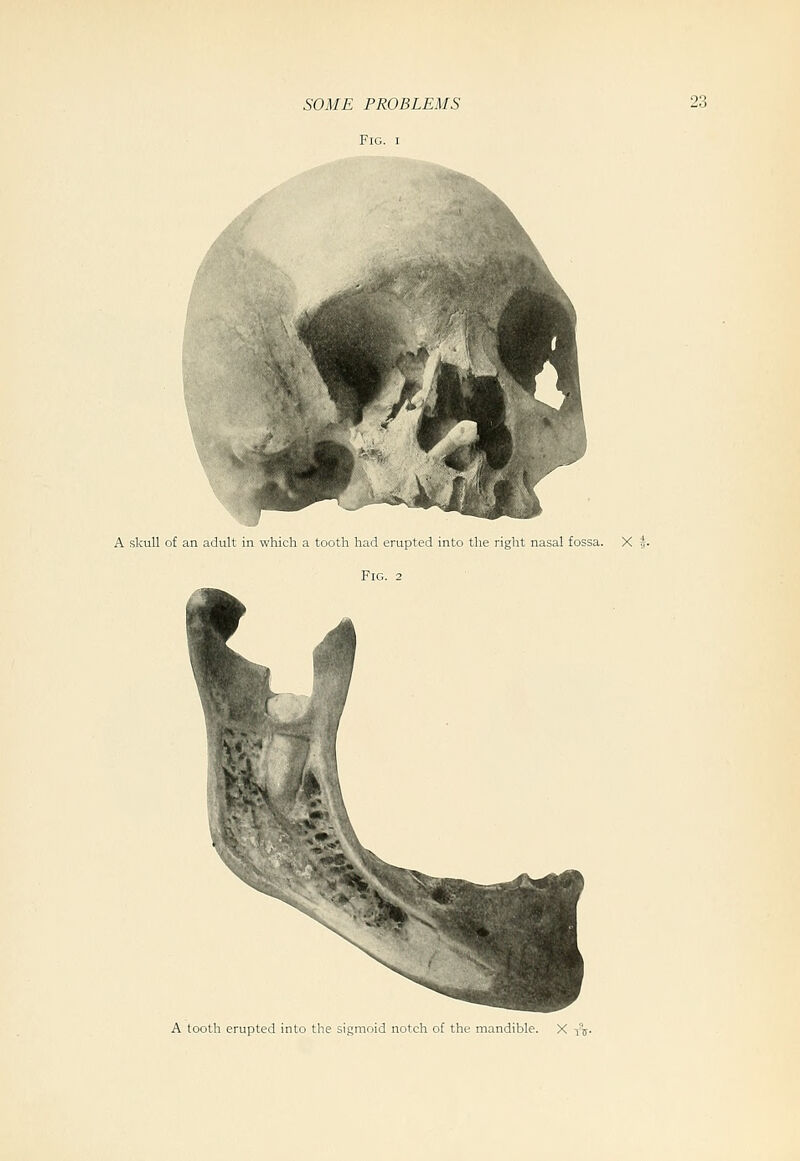 A skull of an adult in which a tooth had erupted into the right nasal fossa. X Fig. 2 A tooth erupted into the sigmoid notch of the mandible. X yjj.