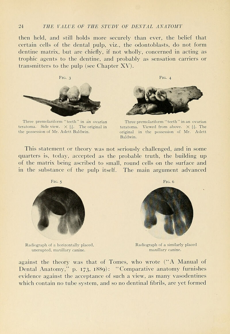 then held, and still holds more securely than ever, the belief that certain cells of the dental pulp, viz., the odontoblasts, do not form dentine matrix, but are chiefly, if not wholly, concerned in acting as trophic agents to the dentine, and probably as sensation carriers or transmitters to the pulp (see Chapter XV). Fig. 3 Three premolariform teeth in an ovarian teratoma. Side view. X H- The original in the possession of Mr. Aslett Baldwin. Fig. 4 Tliree premolariform teeth in an ovarian teratoma. Viewed from above. X jff- The original in the possession of IVIr. Aslett Baldwin. This statement or theory was not seriously challenged, and in some quarters is, today, accepted as the probable truth, the building up of the matrix being ascribed to small, round cells on the surface and in the substance of the pulp itself. The main argument advanced Fig. 5 Fig. 6 Radiograph of a horizontally placed, unerupted, maxillary canine. Radiograph of a similarly placed maxillary canine. against the theory was that of Tomes, who wrote (A Manual of Dental Anatomy, p. 173, 1889): Comparative anatomy furnishes evidence against the acceptance of such a view, as many vasodentines which contain no tube system, and so no dentinal fibrils, are yet formed