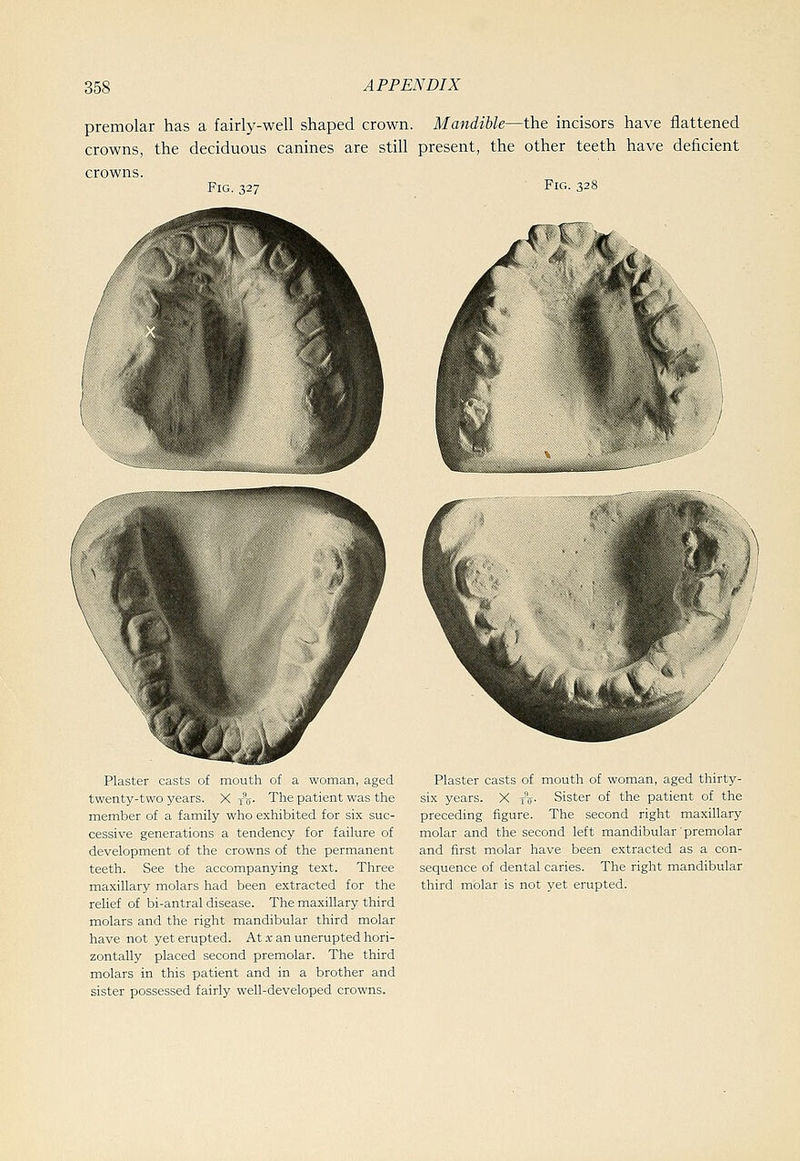 premolar has a fairly-well shaped crown. Mandible—the incisors have flattened crowns, the deciduous canines are still present, the other teeth have deficient crowns. Fig. 327 Fig. 328 Plaster casts of mouth of a woman, aged twenty-two years. X to- The patient was the member of a family who exhibited for six suc- cessive generations a tendency for failure of development of the crowns of the permanent teeth. See the accompanying text. Three maxillary molars had been extracted for the relief of bi-antral disease. The maxillary third molars and the right mandibular third molar have not yet erupted. At x an unerupted hori- zontally placed second premolar. The third molars in this patient and in a brother and sister possessed fairly well-developed crowns. Plaster casts of mouth of woman, aged thirty- six years. X tV- Sister of the patient of the preceding figure. The second right maxillary molar and the second left mandibular premolar and first molar have been extracted as a con- sequence of dental caries. The right mandibular third molar is not yet erupted.