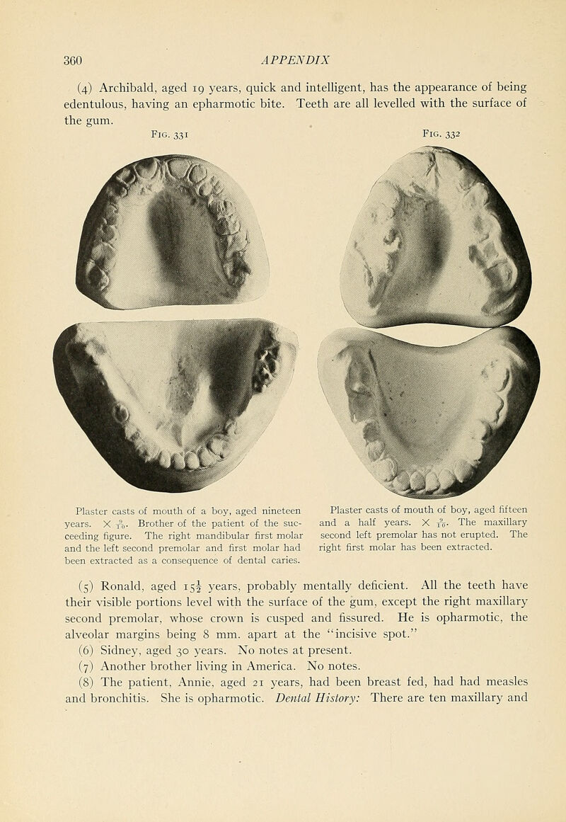 (4) Archibald, aged 19 years, quick and intelligent, has the appearance of being edentulous, having an epharmotic bite. Teeth are all levelled with the surface of the gum. Fig. 331 Plaster casts of mouth of a boy, aged nineteen years. X xo- Brother of the patient of the suc- ceeding figure. The right mandibular first molar and the left second premolar and first molar had been extracted as a consequence of dental caries. Plaster casts of mouth of boy, aged fifteen and a half years. X tb- The maxillary second left premolar has not erupted. The right first molar has been extracted. (5) Ronald, aged 15I years, probably mentally deficient. All the teeth have their visible portions level with the surface of the gum, except the right maxillary second premolar, whose crown is cusped and fissured. He is opharmotic, the alveolar margins being 8 mm. apart at the incisive spot. (6) Sidney, aged 30 years. No notes at present. (7) Another brother living in America. No notes. (8) The patient, Annie, aged 21 years, had been breast fed, had had measles and bronchitis. She is opharmotic. Dental History: There are ten maxillary and