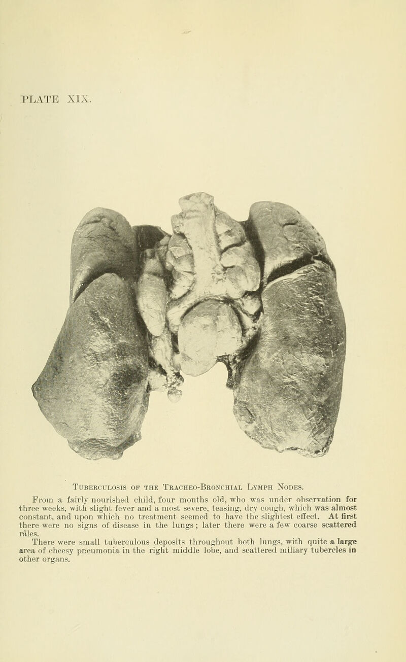 ['LATE XIX. Tuberculosis of the Tracheo-Bronchial Lymph Nodes. From a fairly nourished child, four months old, who was under observation for three weeks, with slight fever and a most severe, teasing, dry cough, which was almost constant, and upon which no treatment seemed to have the slightest effect. At first there were no signs of disease in the lungs; later there were a few coarse scattered rales. There were small tuberculous deposits throughout both lungs, with quite a larpre area of cheesy pneumonia in the right middle lobe, and scattered miliary tubercles in other organs.