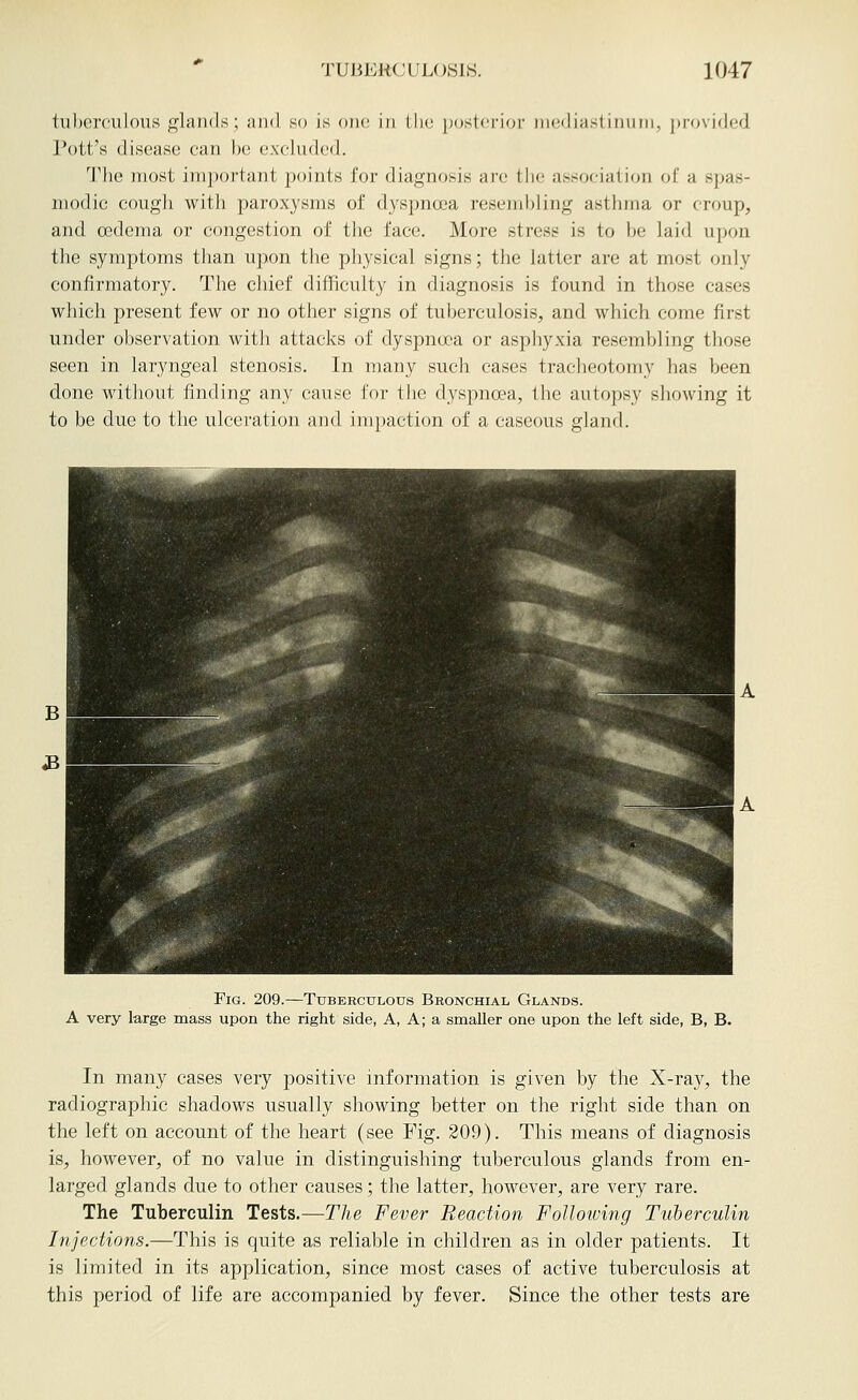 tuberculous glands; and so is oik; in Llie posterior niediaslin\iiii, provided Pott's disease can be excluded. The most important points for diagnosis are the association of a spas- modic cough with paroxysms of dyspnoea resembling asthma or croup, and oedema or congestion of the face. More stress is to be laid upon the symptoms than upon the physical signs; the latter are at most only confirmatory. The chief difficulty in diagnosis is found in those cases which present few or no other signs of tuberculosis, and which come first under observation with attacks of dyspnoea or asphyxia resembling those seen in laryngeal stenosis. In many such cases traclieotomy has been done without finding any cause for the dyspnoea, the autopsy showing it to be due to the ulceration and impaction of a caseous gland. Fig. 209.—Tuberculous Bronchial Glands. A very large mass upon the right side, A, A; a smaller one upon the left side, B, B. In many cases very positive information is given by the X-ra}^, the radiographic shadows usually showing better on the right side than on the left on account of the heart (see Fig. 209). This means of diagnosis is, however, of no value in distinguishing tuberculous glands from en- larged glands due to other causes; the latter, however, are very rare. The Tuberculin Tests.—The Fever Reaction Following Tuberculin Injections.—This is quite as reliable in children as in older patients. It is limited in its application, since most cases of active tuberculosis at this period of life are accompanied by fever. Since the other tests are