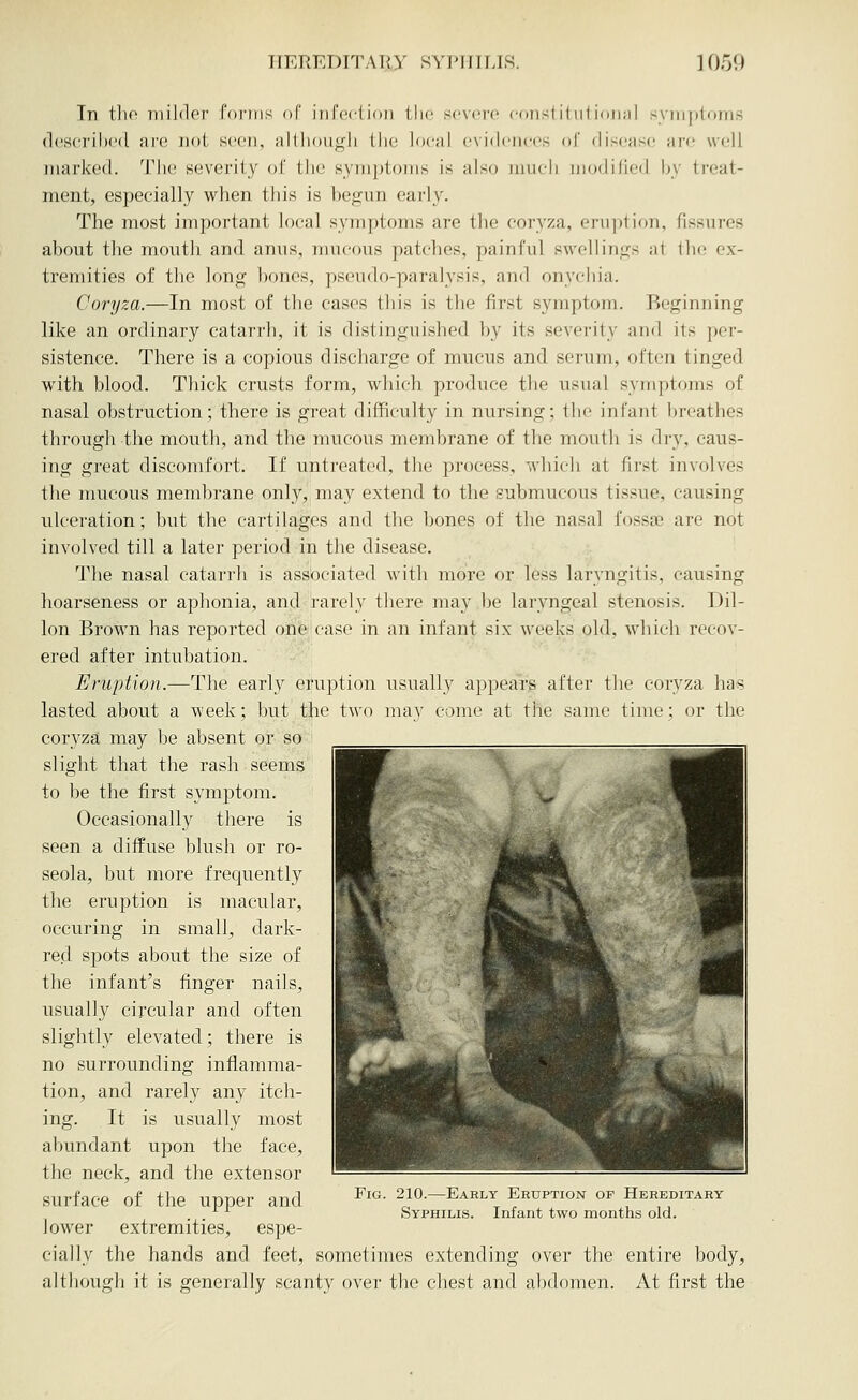 Tn tlio 7iiil(lor' foi'ins of iiircclion llic s^ovoro coiisl il iil ioiinl sviiiplDrns <1('sci'il»('(l iwc. Dot seen, iiltlioii<ili llu; local cn i<lciici's of disoMsc ai'o well marked. Tlie severity of the Hyriiptoins is also luucli modidcil by ti'eat- ment, especially when this is begun early. The most important local symptoms are the coryza, eruption, fissures about the mouth and anus, mucous patches, painful swellings at tlio ex- tremities of the long bones, pseudo-paralysis, and onycliia. Coryza.—In most of the cases this is the first symptom. Beginning like an ordinary catarrh, it is distinguished by its severity and its per- sistence. There is a copious discharge of mucus and serum, often tinged with blood. Thick crusts form, which produce the usual symptoms of nasal obstruction; there is great difficulty in nursing; tlie infant breathes through the mouth, and the mucous membrane of the mouth is dry, caus- ing great discomfort. If untreated, the process, which at first involves the mucous membrane only, may extend to the submucous tissue, causing ulceration; but the cartilages and the bones of the nasal foss£B are not involved till a later period in the disease. The nasal catarrh is associated with more or less laryngitis, causing hoarseness or aphonia, and rarely there may be laryngeal stenosis. Dil- lon Brown has reported one'case in an infant six weeks old, which recov- ered after intubation. Eruption.—The early eruption usually appears after tlie coryza has lasted about a week; but the two may come at the same time; or the coryza may be absent or so slight that the rash seems to be the first symptom. Occasionally there is seen a diffuse blush or ro- seola, but more frequently the eruption is macular, occuring in small, dark- red spots about the size of the infant's finger nails, usually circular and often slightly elevated; there is no surrounding inflamma- tion, and rarely any itch- ing. It is usually most abundant upon the face, the neck, and the extensor surface of the upper and lower extremities, espe- cially the hands and feet, sometimes extending over the entire body, although it is generally scanty over the chest and abdomen. At first the Fig. 210.—Early Eruption of Hereditary Syphilis. Infant two months old.