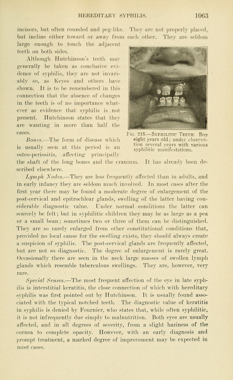 m m .«.• i a 1 v'i m I'iG. 215.—Syphilitic Teeth. Boy eight years old; under observa- tion several years with various syphilitic manifestations. It has already been de- incisors, but often rounded and pc<^-like. They are not properly placed, but incline eitlier toward or away from each other. They are seldom large enough to touch the adjacent teeth on both sides. Altliougli Hutchinson's teeth may generally be taken as conclusive evi- dence of syphili.s, tiiey are not invari- •ably so, as Keyes and others have shown. It is to be remembered in this connection that the absence of changes in the teeth is of no importance what- ever as evidence that syphilis is not present. Hutchinson states that they are wanting in more than lialT the cases. Bones.—The forni of disease which is usually seen at this period is an osteo-periositis, affecting principally the shaft of the long bones and the cranium, scribed elsewliere. Lymph Nodes.—They are less frequently affected than in adults, and in early infancy they are seldom mucli involved. In most cases after the first year there may be found a moderate degree of enlargement of the post-cervical and epitrochlear glands, swelling of the latter having con- siderable diagnostic value. Under normal conditions tlie latter can scarcely be felt; but in syphilitic children they may be as large as a pea or a small bean; sometimes two or three of them can be distinguished. The}' are so rarely enlarged from other constitutional conditions that, provided no local cause for the swelling exists, they should always create a suspicion of syphilis. The post-cervical glands are frequently affected, but are not so diagnostic. The degree of enlargement is rarely great. Occasionally there are seen in the neck large masses of swollen lymph glands which resemble tuberculous swellings. They are, however, very rare. Special Senses.—The most frequent affection of the eye in late syph- ilis is interstitial keratitis, the close connection of which with hereditary syphilis was first pointed out by Hntchinson. It is usually found asso- ciated with the typical notched teeth. The diagnostic value of keratitis in syphilis is denied by Fournier, who states that, while often syphilitic, it is not infrequently due simply to malnutrition. Both eyes are usually affected, and in all degrees of severity, from a slight haziness of the cornea to complete opacity. However, with an early diagnosis and ]jrompt treatment, a marked degree of improvement may be expected in most cases.