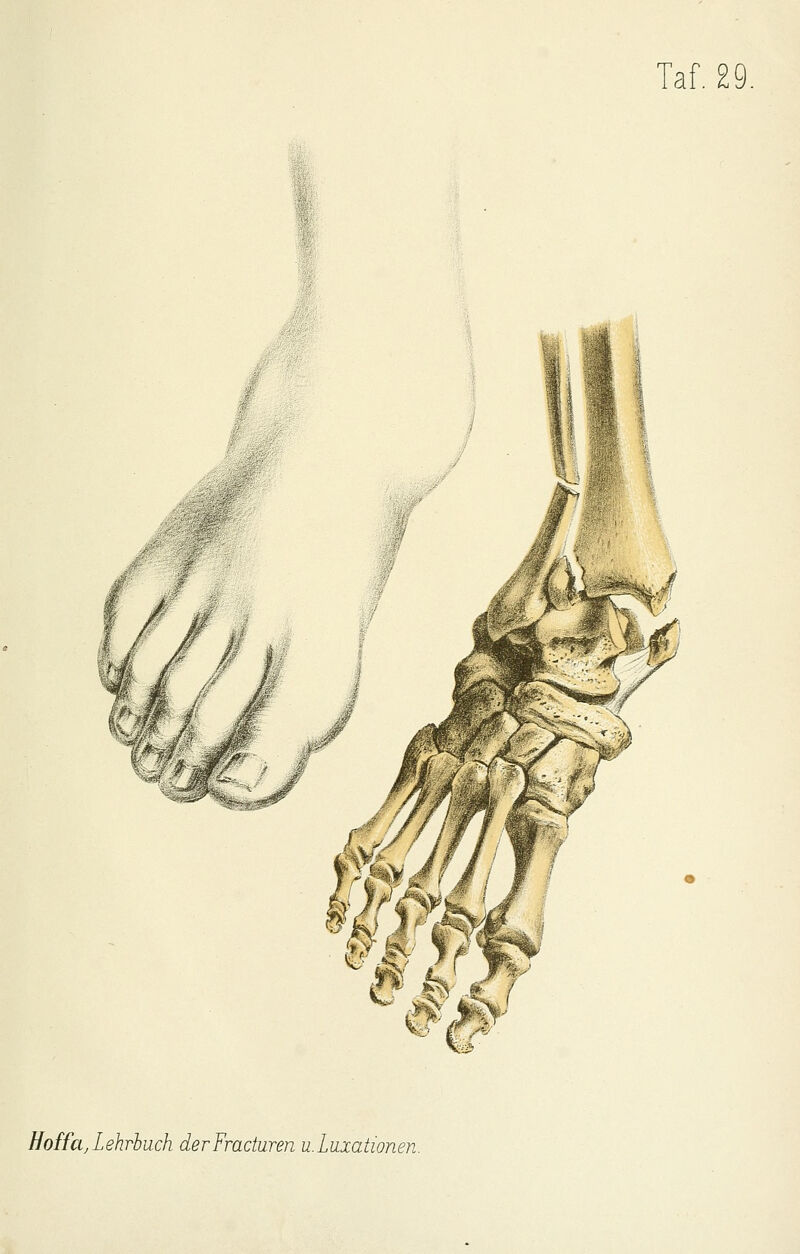 Hoffet,Lehrlüch derFraduren u.Luxationen.