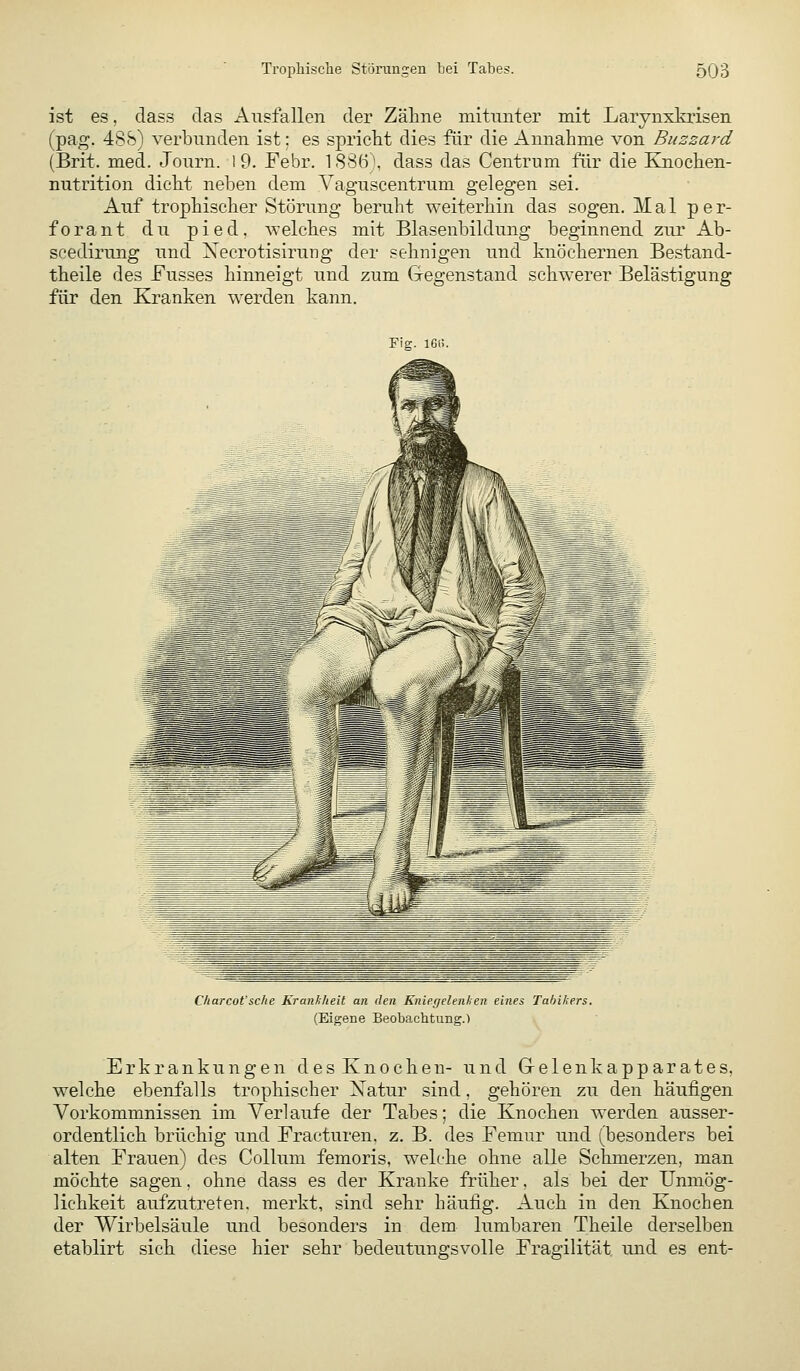 ist es, dass das Ausfallen der Zähne mitunter mit Larynxkrisen (pag. 488) verbunden ist: es spricht dies für die Annahme von Blizzard (Brit. med. Journ. 1 9. Febr. 1 88ö\ dass das Centrum für die Knochen- nutrition dicht neben dem Vaguscentrum gelegen sei. Auf trophischer Störung beruht weiterhin das sogen. Mal p e r- forant du pied, welches mit Blasenbildung beginnend zur Ab- scedirung und Xecrotisirung der sehnigen und knöchernen Bestand- theile des Fusses hinneigt und zum Gegenstand schwerer Belästigung für den Kranken werden kann. Fig. 160. Cliarcot'sche Kranhheit an den Knieyeleiihen eines Tahikers. (Eigene Beobachtung.) Erkrankungen desKnochen- und G-elenkapparates, welche ebenfalls trophischer Xatur sind, gehören zu den häufigen Vorkommnissen im Verlaufe der Tabes; die Knochen werden ausser- ordentlich brüchig und Fracturen, z. B. des Femur und (besonders bei alten Frauen) des Collum femoris, welche ohne alle Schmerzen, man möchte sagen. ohne dass es der Kranke früher, als bei der Unmög- lichkeit aufzutreten, merkt, sind sehr häufig. Auch in den Knochen der Wirbelsäule und besonders in dem lumbaren Theile derselben etablirt sich diese hier sehr bedeutungsvolle Fragilität und es ent-