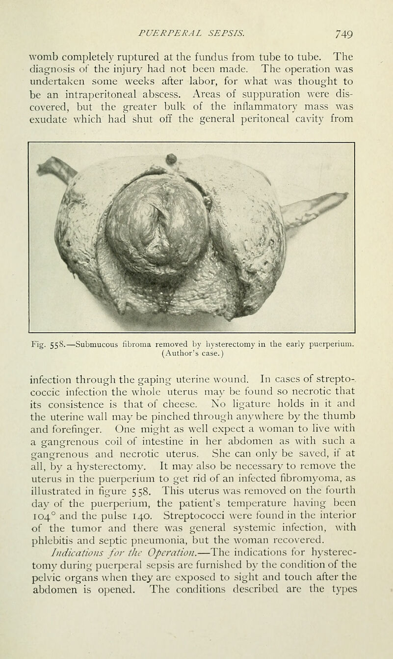 womb completely ruptured at the fundus from tube to tube. The diagnosis ot the injury had not been made. The operation was undertaken some weeks after labor, for what was thought to be an intraperitoneal abscess. Areas of suppuration were dis- covered, but the greater bulk of the inflammatory mass was exudate which had shut off the general peritoneal cavity from Fig. 558.—Submucous llbronia removed by hysterectomy in the early puerperium. (Author's case.) infection through the gaping uterine wound. In cases of strepto-, coccic infection the whole uterus may be found so necrotic that its consistence is that of cheese. No hgature holds in it and the uterine wall may be pinched through anywhere by the thumb and forefinger. One might as well expect a woman to live with a eanerenous coil of intestine in her abdomen as with such a gangrenous and necrotic uterus. She can only be saved, if at all, by a hysterectomy. It may also be necessary to remove the uterus in the puerperium to get rid of an infected fibromyoma, as illustrated in figure 558. This uterus was removed on the fourth day of the puerperium, the patient's temperature having been 104° and the pulse 140. Streptococci were ibund in the interior of the tumor and there was general systemic infection, with phlebitis and septic pneumonia, but the woman recovered. Indications for the Operation.—The indications for h)-sterec- tomy during puerperal sepsis arc furnished by the condition of the pelvic organs when they are exposed to sight and touch after the abdomen is opened. The conditions descriljied are the ty])es