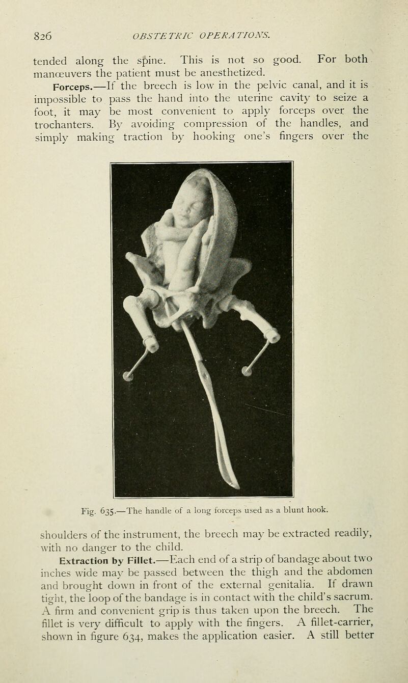 tended along the spine. This is not so good. For both manoeuvers the patient must be anesthetized. Forceps.—If the breech is low in the pelvic canal, and it is impossible to pass the hand into the uterine cavity to seize a foot, it may be most convenient to apply forceps over the trochanters. By avoiding compression of the handles, and simply making traction by hooking one's fingers over the Fig. 635.—The handle of a long forceps used as a blunt hook. shoulders of the instrument, the breech ma}' be extracted readily, with no danger to the child. Extraction by Fillet,—Each end of a strip of bandage about two inches wide may be passed between the thigh and the abdomen and brought down in front of the external genitalia. If drawn tight, the loop of the bandage is in contact with the child's sacrum. A firm and convenient grip is thus taken upon the breech. The fillet is very difficult to apply with the fingers. A fillet-carrier, shown in figure 634, makes the application easier. A still better