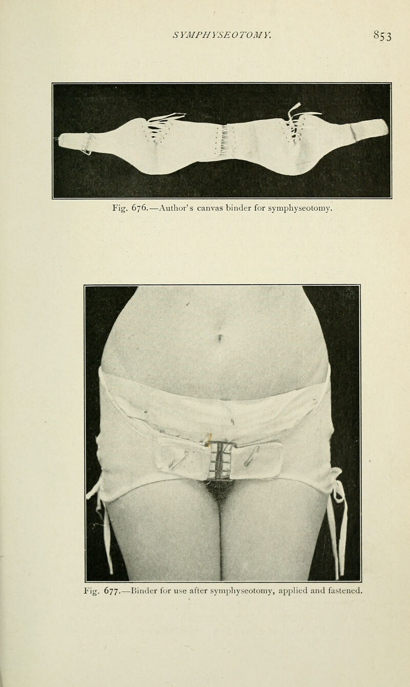 Fig. 676.—Author's canvas binder for symphyseotomy. I'ig. 677. — Iliiiclcr fur UMi alltr symiiliyseotoniy, a[)[)lic(-l and lasltncd.