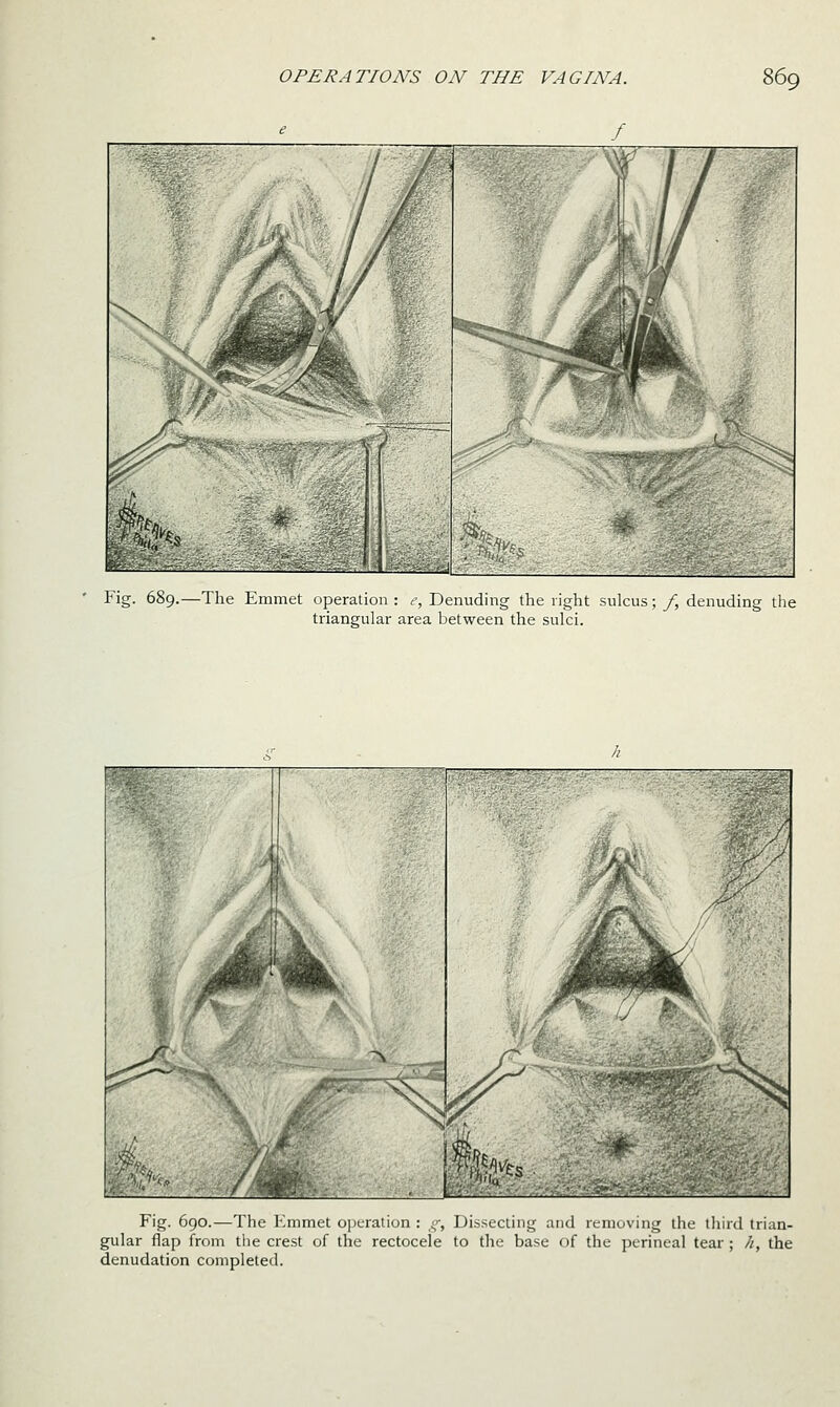 f Fig. 689.—The Emmet operation : ,-, J denuding the right sulcus; f, denuding the triangular area between the sulci. Fig. 690.—The Emmet oijcralion : t;. Dissecting and removing the third trian- gular flap from the crest of the rectocele to tlie base of the perineal tear; h, the denudation completed.