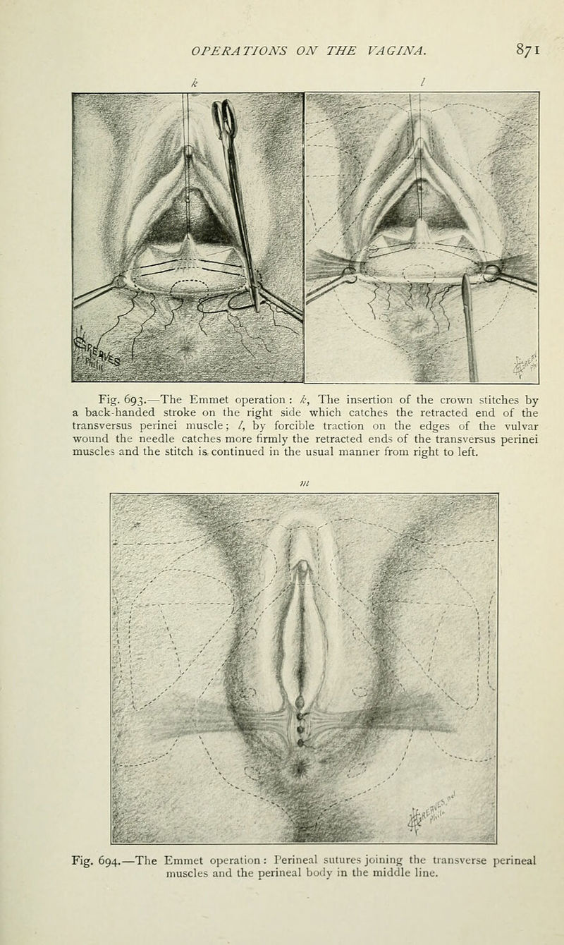 k I 1 i,^'- ''9,v 'i 1' 1-iiiiiiel operation : k, The insertion of the crown stitches by a back-handed stroke on the right side which catches the retracted end of the transversus perinei muscle; /, by forcible traction on the edges of the vulvar wound the needle catches more firmly the retracted ends of the transversus perinei muscles and the stitch is continued in the usual manner from right to left. Fig. 694.—The Emmet operation: Perineal sutures joining the transverse perineal muscles and the perineal body in the middle line.