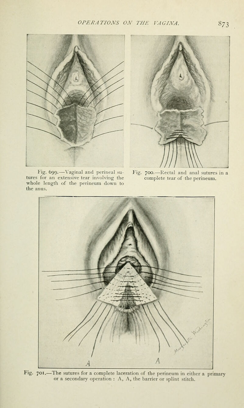 ^71 Fig. 699.—Vaginal and perineal su- Fig. 700.—Rectal and anal sutures in a tores for an extensive tear involving the complete tear of the perineum, whole length of the perineum down to the anus. Fig. 701.—The sutures for a complete laceration of the perineum in either a primary or a secondary operation : A, A, the harrier or splint stitch.