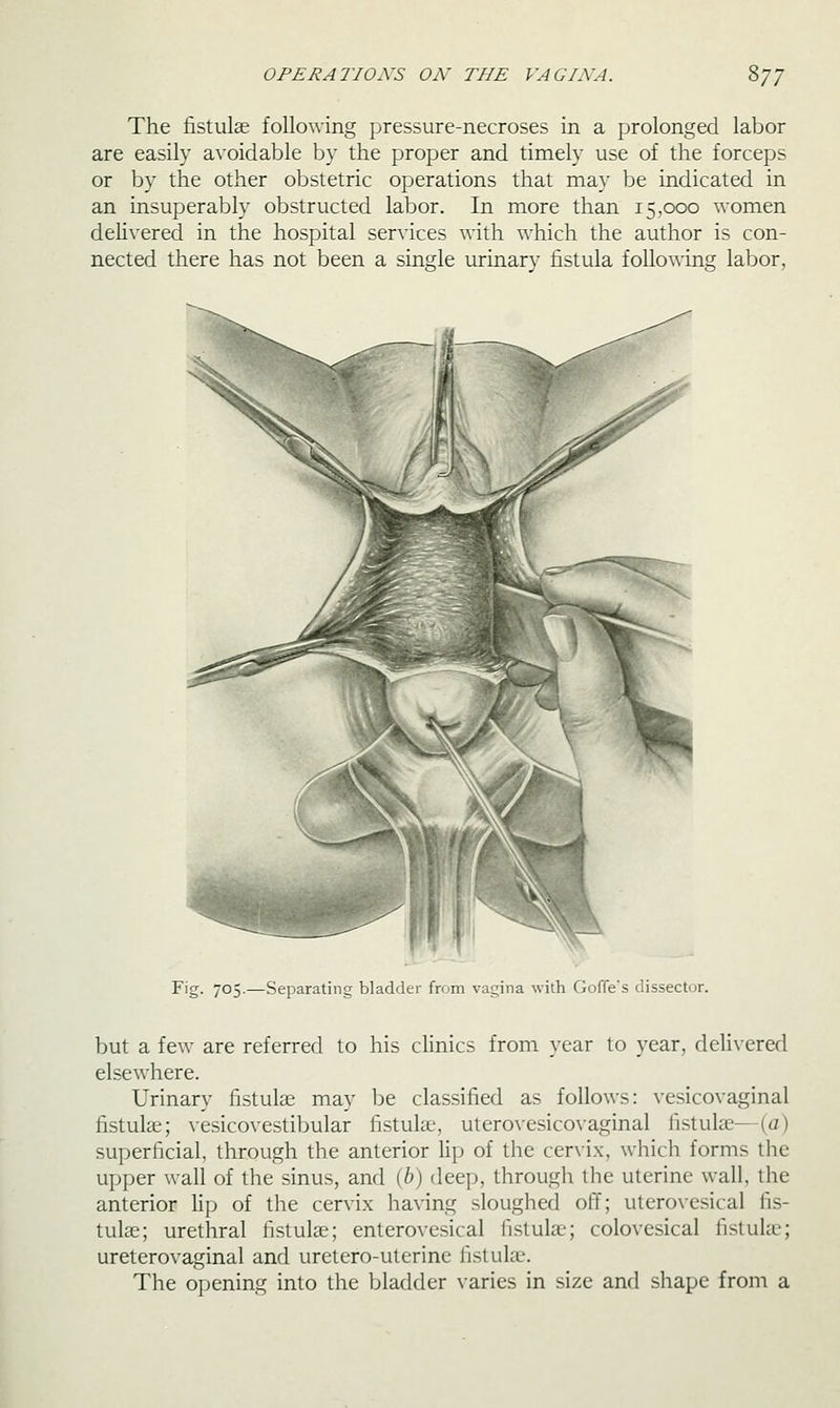 The fistulae following pressure-necroses in a prolonged labor are easily avoidable by the proper and timely use of the forceps or by the other obstetric operations that may be indicated in an insuperably obstructed labor. In more than 15,000 women dehvered in the hospital services with which the author is con- nected there has not been a single urinary fistula following labor, Fig- 705.—Separating bladder from vagina with Goffes dissector. but a few are referred to his clinics from year to year, deli\-ered elsewhere. Urinary fistulae may be classified as follows: vesicovaginal fistula;; vesicovestibular fistulae, uterovesicovaginal fistuke—(a) superficial, through the anterior lip of the cervix, which forms the upper wall of the sinus, and [h) deej), through the uterine wall, the anterior Up of the cervix having sloughed off; uterovcsical fis- tulae; urethral fistulae; enterovesical fistula-; colovesical fistulae; ureterovaginal and uretero-uterine fistulae. The opening into the bladder varies in size and shape from a