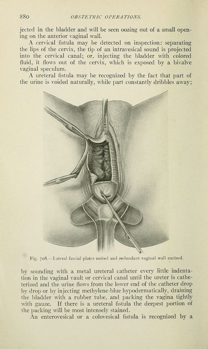 jected in the bladder and will be seen oozing out of a small open- ing on the anterior vaginal wall. A cervical fistula may be detected on inspection: separating the lips of the cervix, the tip of an intravesical sound is projected into the cervical canal; or, injecting the bladder with colored fluid, it flows out of the cervix, which is exposed by a bivalve vaginal speculum. A ureteral fistula may be recognized by the fact that part of the urine is voided naturally, wdiile part constantly dribbles away; Fig. 708.—Lateral fascial plates united and redundant vaginal wall excised. by sounding with a metal ureteral catheter every little indenta- tion in the vaginal vault or cervical canal until the ureter is cathe- terized and the urine flows from the lower end of the catheter drop by drop or by injecting methylene-blue hypodermatically, draining the bladder with a rubber tube, and packing the vagina tightly with gauze. If there is a ureteral fistula the deepest portion of the packing will be most intensely stained. An enterovesical or a colovesical fistula is recognized by a