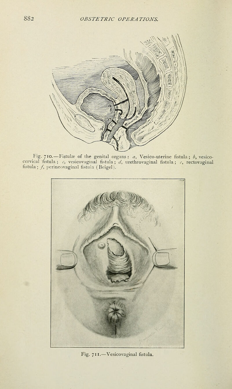 Fig. 710.—Fistulse of the genital organs: a, Vesico-uterine fistula; b, vesico- cervical fistula ; c, vesicovaginal fistula; d, urethrovaginal fistula; e, rectovaginal fistula; y, perineovaginal fistula (Beigel). Fig. 711.—Vesicovaginal fistula.