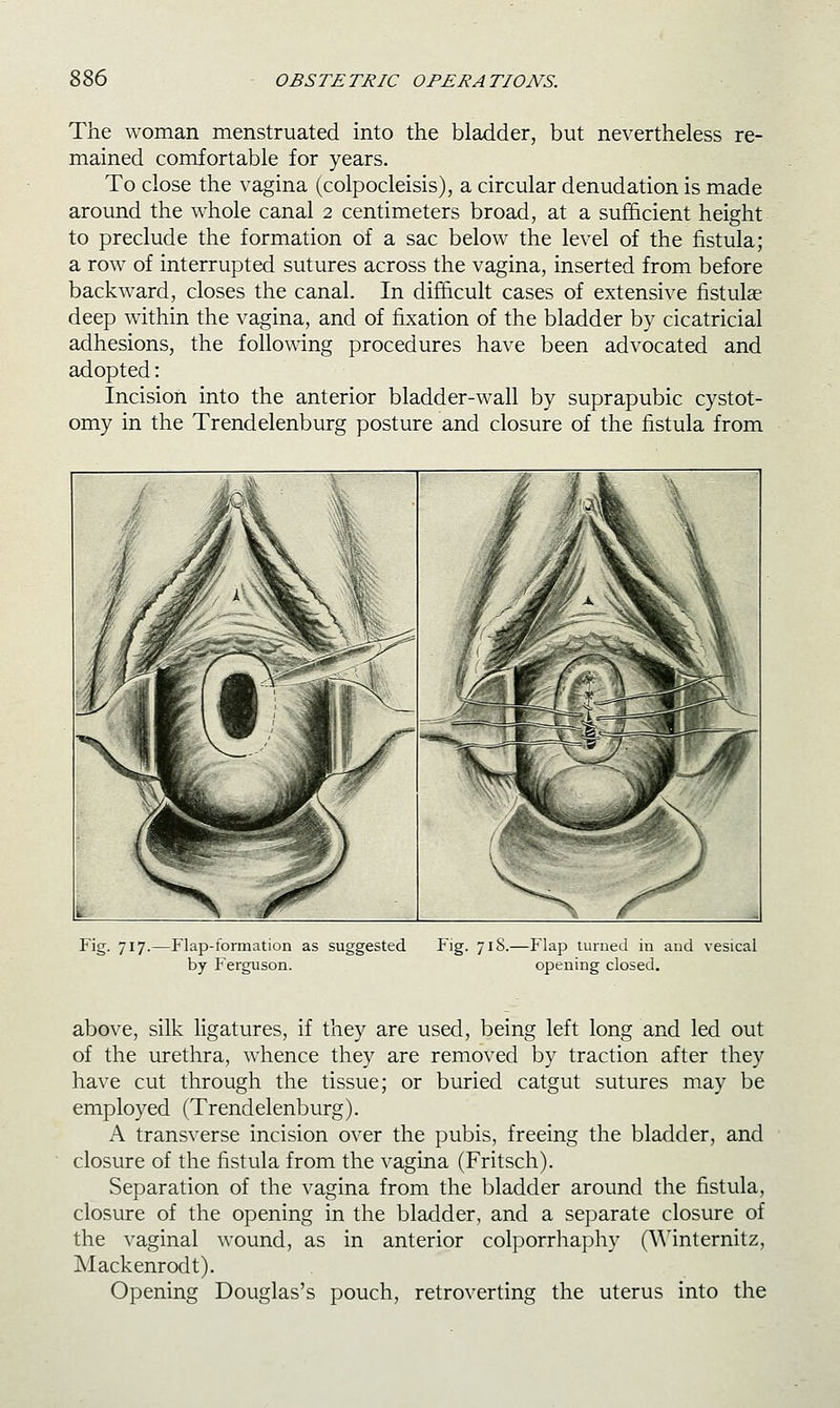 The woman menstruated into the bladder, but nevertheless re- mained comfortable for years. To close the vagina (colpocleisis), a circular denudation is made around the whole canal 2 centimeters broad, at a sufficient height to preclude the formation of a sac below the level of the fistula; a row of interrupted sutures across the vagina, inserted from before backward, closes the canal. In difficult cases of extensive fistulge deep within the vagina, and of fixation of the bladder by cicatricial adhesions, the following procedures have been advocated and adopted: Incision into the anterior bladder-wall by suprapubic cystot- omy in the Trendelenburg posture and closure of the fistula from Fig. 717. -Flap-formation as suggested by Ferguson. Fig. 71S.—Flap turned in and vesical opening closed. above, silk ligatures, if they are used, being left long and led out of the urethra, whence they are removed by traction after they have cut through the tissue; or buried catgut sutures may be employed (Trendelenburg). A transverse incision over the pubis, freeing the bladder, and closure of the fistula from the vagina (Fritsch). Separation of the vagina from the bladder around the fistula, closure of the opening in the bladder, and a separate closure of the vaginal wound, as in anterior colporrhaphy (\\^internitz, Mackenrodt). Opening Douglas's pouch, retroverting the uterus into the