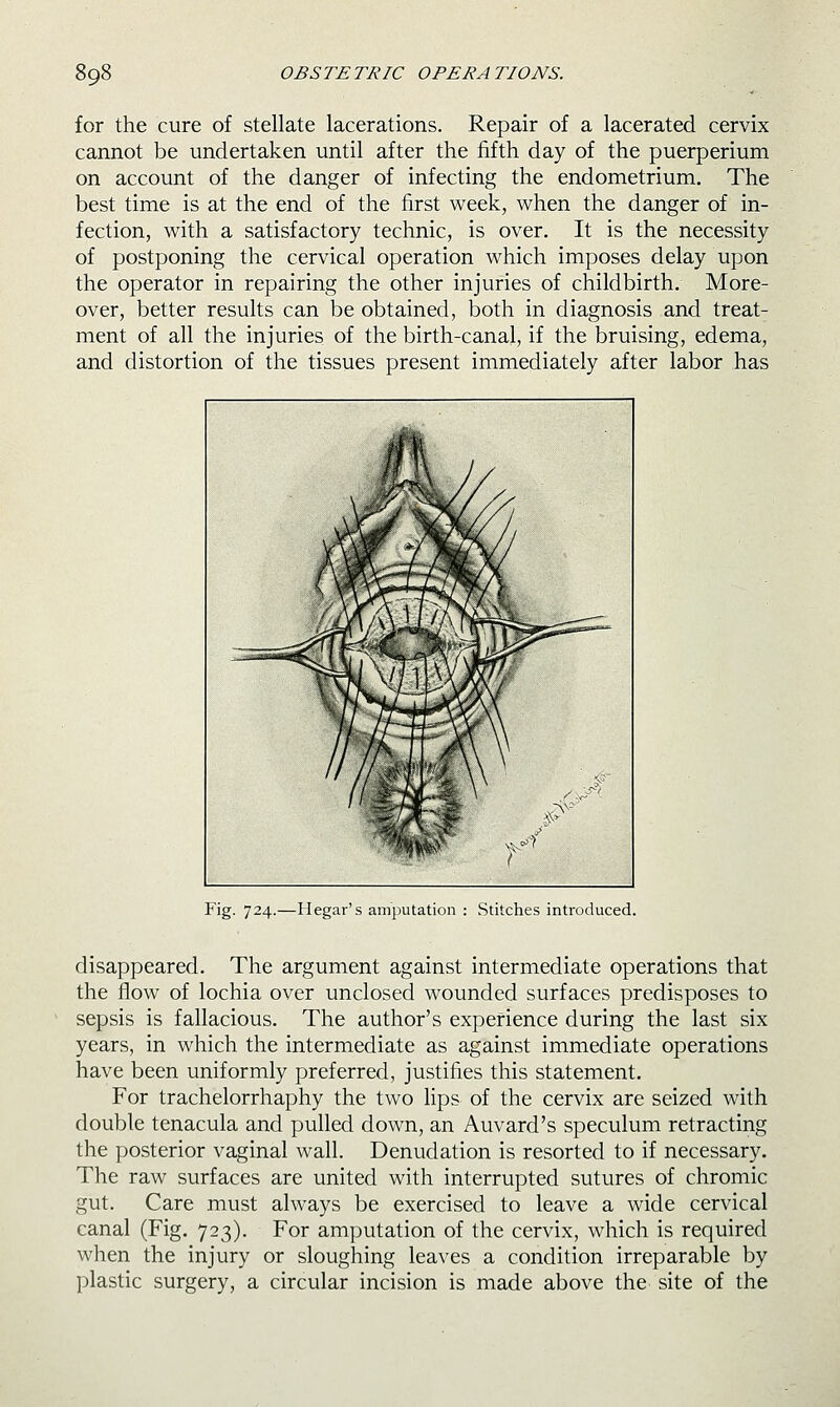 for the cure of stellate lacerations. Repair of a lacerated cervix cannot be undertaken until after the fifth day of the puerperium on account of the danger of infecting the endometrium. The best time is at the end of the first week, when the danger of in- fection, with a satisfactory technic, is over. It is the necessity of postponing the cervical operation which imposes delay upon the operator in repairing the other injuries of childbirth. More- over, better results can be obtained, both in diagnosis and treat- ment of all the injuries of the birth-canal, if the bruising, edema, and distortion of the tissues present immediately after labor has Fig. 724.—Hegar's amputation : Stitches introduced. disappeared. The argument against intermediate operations that the flow of lochia over unclosed wounded surfaces predisposes to sepsis is fallacious. The author's experience during the last six years, in which the intermediate as against immediate operations have been uniformly preferred, justifies this statement. For trachelorrhaphy the two lips of the cervix are seized with double tenacula and pulled down, an Auvard's speculum retracting the posterior vaginal wall. Denudation is resorted to if necessary. The raw surfaces are united with interrupted sutures of chromic gut. Care must always be exercised to leave a wide cervical canal (Fig. 723). For amputation of the cervix, which is required when the injury or sloughing leaves a condition irreparable by plastic surgery, a circular incision is made above the site of the