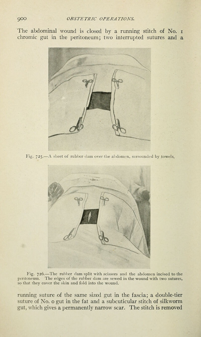 The abdominal wound is closed by a running stitch of No. i chromic gut in the peritoneum; two interrupted sutures and a Fig. 725.—A sheet of rubber dam over the abdomen, surrounded by towels. Fig. 726.—The rubber dam split with scissors and the abdomen incised to the peritoneum. The edges of the rubber dam are sewed in the wound with two sutures, so that they cover the skin and fold into the wound. running suture of the same sized gut in the fascia; a double-tier suture of No. o gut in the fat and a subcuticular stitch of silkworm gut, which gives a permanently narrow scar. The stitch is removed