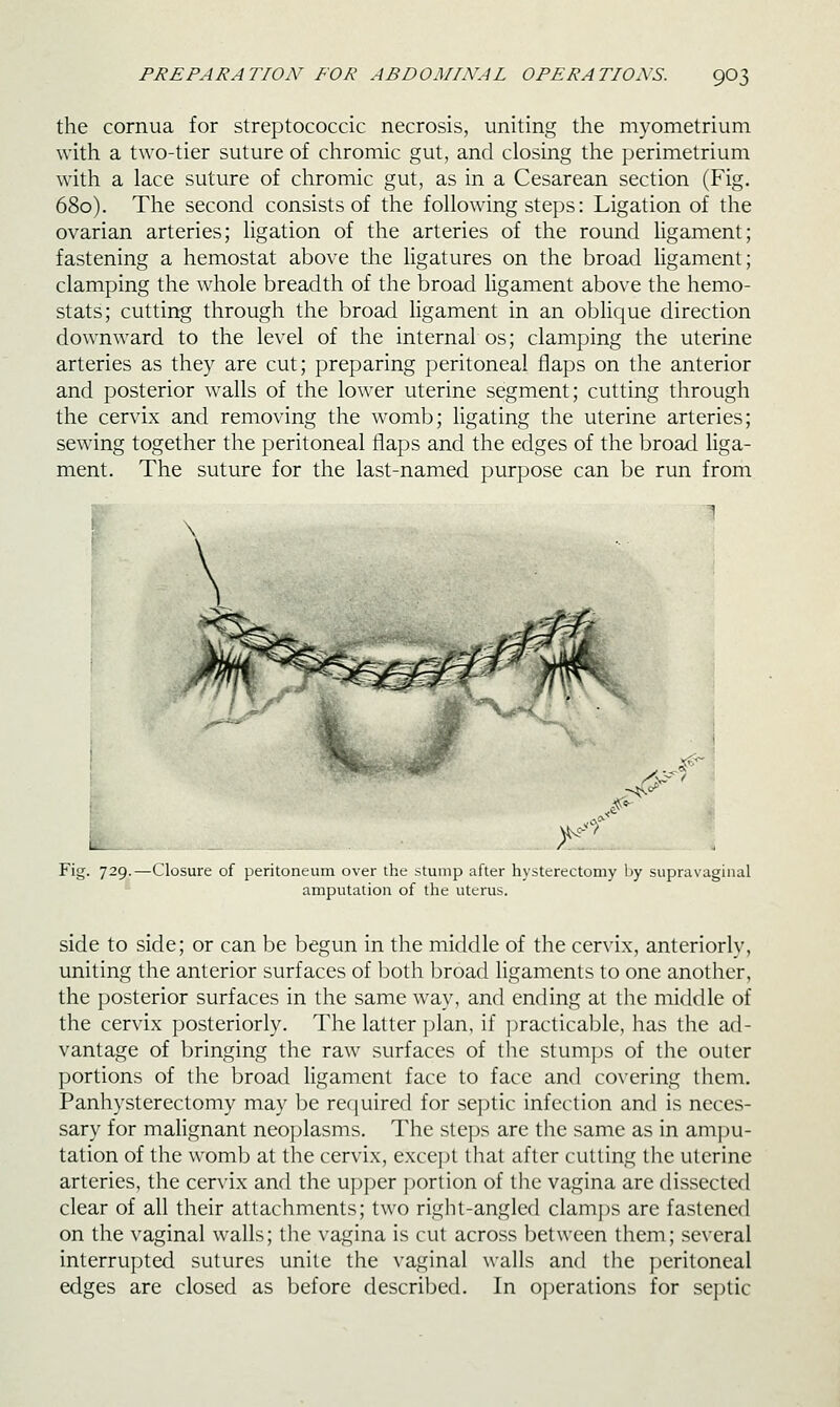 the cornua for streptococcic necrosis, uniting the myometrium with a two-tier suture of chromic gut, and closing the perimetrium with a lace suture of chromic gut, as in a Cesarean section (Fig. 680). The second consists of the foHowing steps: Ligation of the ovarian arteries; ligation of the arteries of the round ligament; fastening a hemostat above the ligatures on the broad ligament; clamping the whole breadth of the broad ligament above the hemo- stats; cutting through the broad ligament in an oblique direction downward to the level of the internal os; clamping the uterine arteries as they are cut; preparing peritoneal flaps on the anterior and posterior walls of the lower uterine segment; cutting through the cervix and removing the womb; ligating the uterine arteries; sewing together the peritoneal flaps and the edges of the broad liga- ment. The suture for the last-named purpose can be run from Fig. 729.—Closure of peritoneum over the stump after hysterectomy by supravaginal amputation of the uterus. side to side; or can be begun in the middle of the cervix, anteriorly, uniting the anterior surfaces of both broad ligaments to one another, the posterior surfaces in the same way, and ending at the middle of the cervix posteriorly. The latter jjlan, if jjracticable, has the ad- vantage of bringing the raw surfaces of the stumps of the outer portions of the broad ligament face to face and covering them. Panhysterectomy may be required for septic infection and is neces- sary for malignant neoplasms. The steps are the same as in ampu- tation of the womb at the cervix, except that after cutting the uterine arteries, the cervix and the upper i)ortion of the vagina are dissected clear of all their attachments; two right-angled clamps are fastened on the vaginal walls; the vagina is cut across between them; several interrupted sutures unite the vaginal walls and the peritoneal edges are closed as before described. In ojjerations for septic