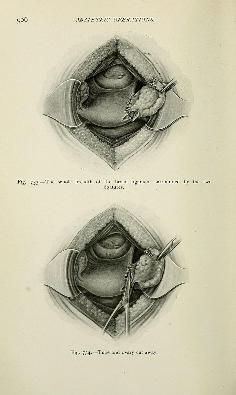 Fig. 733.—The whole breadth of the broad ligament surrounded by the two ligatures. Fig. 734.—Tube and ovary cut away.