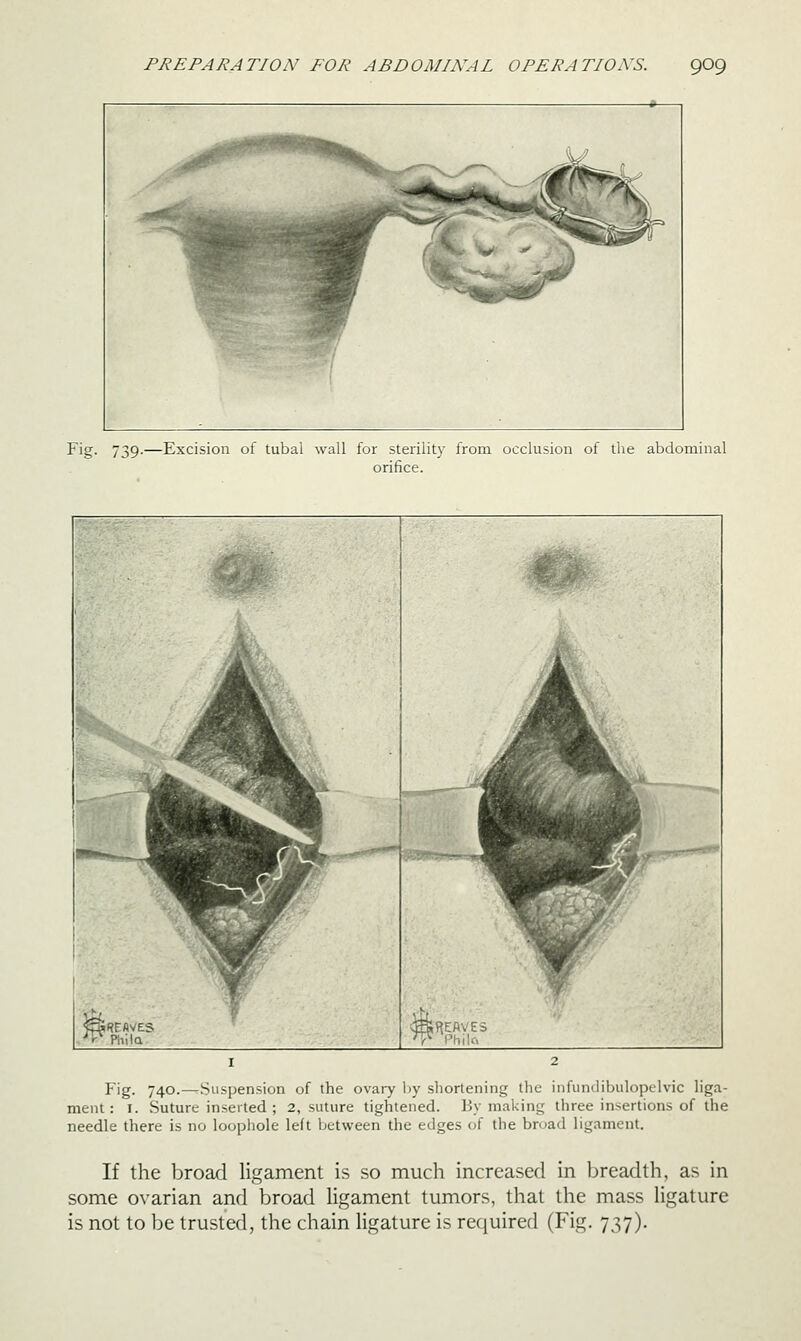 Fig. 739.—Excision of tubal wall for sterility from occlusion of the abdominal orifice. Fig. 740.—.Suspension of the ovary by shortening the infundibulopelvic liga- ment: I. Suture inserted ; 2, suture tightened. By making three insertions of the needle there is no loophole left between the edges of the broad ligament. If the broad ligament is so much increased in breadth, as in some ovarian and broad ligament tumors, that the mass ligature is not to be trusted, the chain ligature is required (Fig. 737).