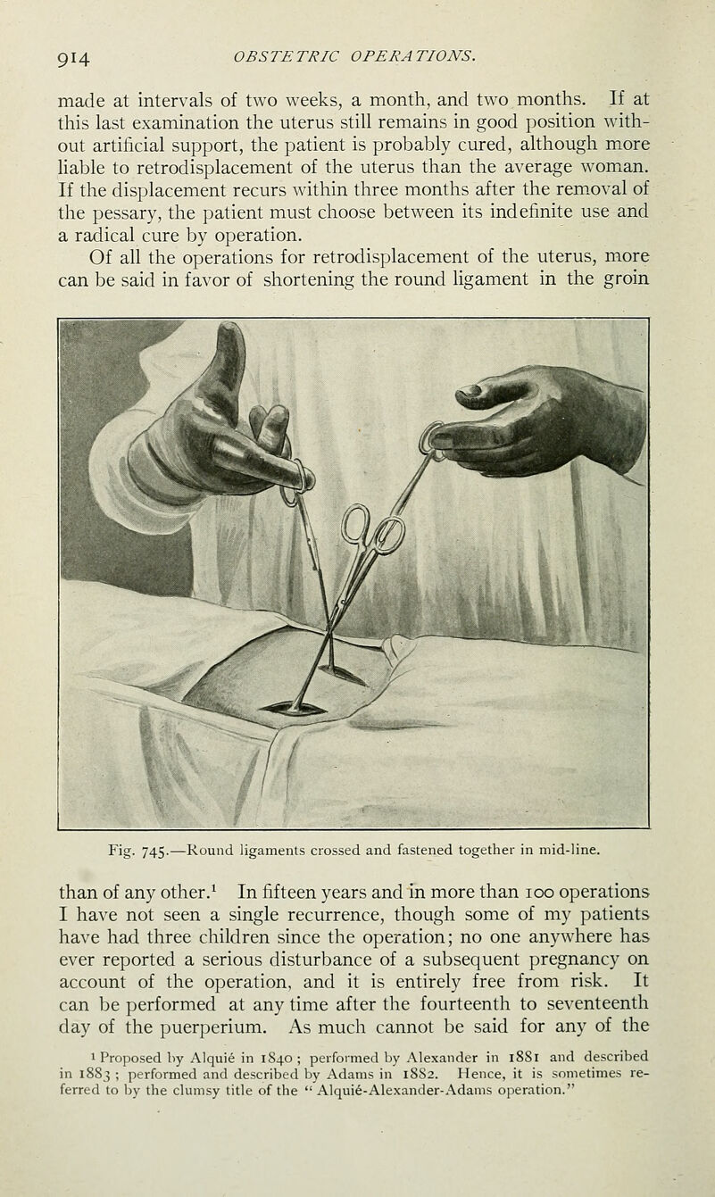 made at intervals of two weeks, a month, and two months. If at this last examination the uterus still remains in good position with- out artificial support, the patient is probably cured, although more liable to retrodisplacement of the uterus than the average woman. If the displacement recurs within three months after the removal of the pessary, the patient must choose between its indefinite use and a radical cure by operation. Of all the operations for retrodisplacement of the uterus, more can be said in favor of shortening the round ligament in the groin Fig. 745.—Round ligaments crossed and fastened together in mid-line. than of any other.^ In fifteen years and In more than 100 operations I have not seen a single recurrence, though some of my patients have had three children since the operation; no one anywhere has ever reported a serious disturbance of a subsequent pregnancy on account of the operation, and it is entirely free from risk. It can be performed at any time after the fourteenth to seventeenth day of the puerperium. As much cannot be said for any of the 1 Proposed by Alquie in 1S40; performed by Alexander in 1881 and described in 1883 ; performed and described by Adams in 1882. Hence, it is sometimes re- ferred to by the clumsy title of the  Alquie-Alexander-Adams operation.