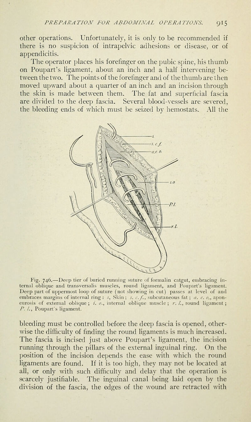 Other operations. Unfortunately, it is only to be recommended if there is no suspicion of intrapelvic adhesions or disease, or of appendicitis. The operator places his forefinger on the pubic spine, his thumb on Poupart's ligament, about an inch and a half intervening be- tween the two. The points of the forefinger and of the thumb are then moved upward about a quarter of an inch and an incision through the skin is made between them. The fat and superficial fascia are divided to the deep fascia. Several blood-\'essels are severed, the bleeding ends of which must be seized by hemostats. All the Fig. 746.—Deep tier of buried running suture of formalin catgut, embracing in- ternal oblique and transversalis muscles, round ligament, and Poupart's ligament. Deep part of uppermost loop of suture (not showing in cut) passes at level of and embraces margins of internal ring: .f, Skin; s. c.f., subcutaneous fat ; a. e. o., apon- eurosis of external oblique; /. o., internal oblique muscle; r. /., round ligament; /'. /., Poupart's ligament. bleeding must be controlled before the deep fascia is opened, other- wise the difficulty of finding the round ligaments is much increased. The fascia is incised just above Poupart's ligament, the incision running through the pillars of tlie external inguinal ring. On the ])Osition of the incision depends the ease with which the round ligaments are found. If it is too high, they may not be located at all, or only with such dift'iculty and delay that the o])eration is scarcely justifiable. The inguinal canal being laid open by the division of the fascia, the edges of the wound are retracted with