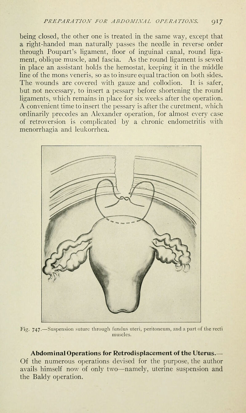 being closed, the other one is treated in the same way, except that a right-handed man naturally passes the needle in reverse order through Poupart's ligament, floor of inguinal canal, round liga- ment, oblique muscle, and fascia. As the round ligament is sewed in place an assistant holds the hemostat, keeping it in the middle line of the mons veneris, so as to insure equal traction on both sides. The wounds are covered with gauze and collodion. It is safer, but not necessary, to insert a pessary before shortening the round ligaments, which remains in place for six weeks after the operation. A convenient time to insert the pessary is after the curetment, which ordinarily precedes an Alexander operation, for almost every case of retroversion is complicated by a chronic endometritis with menorrhaffia and leukorrhea. Fig. 747.—Suspension suture tlirough fundus uteri, peritoneum, and a part of the recti muscles. Abdominal Operations for Retrodisplacement of the Uterus.— Of the numerous operations devised for the purpose, the author avails himself now of only two—namely, uterine suspension and the Baldy operation.