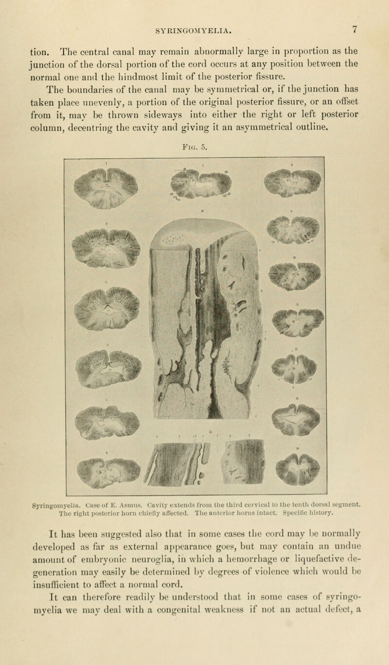 tion. The central canal may remain abnormally large in proportion as the junction of the dorsal portion of the cord occurs at any position between the normal one and the hindmost limit of the posterior fissure. The boundaries of the canal may be symmetrical or, if the junction has taken place unevenly, a portion of the original posterior fissure, or an offset from it, may be thrown sideways into either the right or left posterior column, decentring the cavity and giving it an asymmetrical outline. Fig. 5. Syringomyelia. Case ol E. Asmus. < larity extends from the third cervical to the tenth dorsal segment. TIm' right posterior horn chiefly affected. The anterior horns intact. Specific history. It has been suggested also that in some cases the cord may be normally developed as far as external appearance goes, but may contain an undue amount of embryonic neuroglia, in which a hemorrhage or liquefactive de- generation may easily be determined by degrees of violence which would be insufficient to affect a normal cord. It can therefore readily be understood that in some cases of syringo- myelia we may deal with a congenital weakness if not an actual defect, a