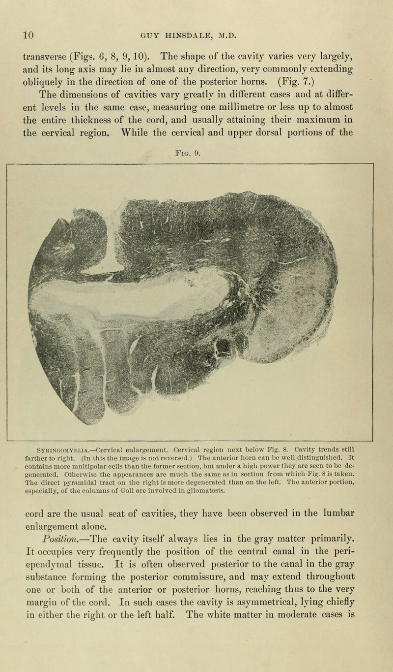 transverse (Figs. 6, 8, 9, 10). The shape of the cavity varies very largely, and its long axis may lie in almost any direction, very commonly extending obliquely in the direction of one of the posterior horns. (Fig. 7.) The dimensions of cavities vary greatly in different cases and at differ- ent levels in the same case, measuring one millimetre or less up to almost the entire thickness of the cord, and usually attaining their maximum in the cervical region. While the cervical and upper dorsal portions of the Fig. 9. Syringomyelia.—Cervical enlargement. Cervical region next below Fig. 8. Cavity trends still farther to right. (In this the image is not reversed.) The anterior horn can be well distinguished. It contains more multipolar cells than the former section, but under a high power they are seen to be de- generated. Otherwise the appearances are much the same as in section from which Fig. 8 is taken. The direct pyramidal tract on the right is more degenerated than on the left. The anterior portion, especially, of the columns of Goll are involved in gliomatosis. cord are the usual seat of cavities, they have been observed in the lumbar enlargement alone. Position.—The cavity itself always lies in the gray matter primarily. It occupies very frequently the position of the central canal in the peri- ependymal tissue. It is often observed posterior to the canal in the gray substance forming the posterior commissure, and may extend throughout one or both of the anterior or posterior horns, reaching thus to the very margin of the cord. In such cases the cavity is asymmetrical, lying chiefly in either the right or the left half. The white matter in moderate cases is