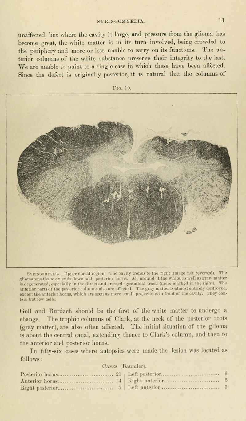unaffected, but where the cavity is large, and pressure from the glioma has become great, the white matter is in its turn involved, being crowded to the periphery and more or less unable to carry on its functions. The an- terior columns of the white substance preserve their integrity to the last. We are unable to point to a single case in which these have been affected. Since the defect is originally posterior, it is natural that the columns of Fig. 10. Syringomyelia.—Upper dorsal region. The cavity trends to the right (image not reversed). The glioinatous tissue extends down both posterior hums. All around It the white, as well as gray, matter nerated, especially in the direct and crossed pyramidal tracts (mure marked in the right). The anterior parts of the posterior columns also are affected. The gray matter is almost entirely destroyed, except the anterior horns, which are seen as mere small projections in front of the cavity. They con- tain l.ut few cells. Goll and Burdach should be the first of the white matter to undergo a change. The trophic columns of Clark, at the neck of the posterior roots (gray matter), are also often affected. The initial situation of the glioma is about the central canal, extending thence to Clark's column, and then to the anterior and posterior horns. In fifty-six cases where autopsies were made the lesion was located as follows : (' \-i.- | Baumler . Posterior horns 21 Left posterior 6 Anterior home 11 Right anterior 5 Right posterior 5 Lefl anterior 5