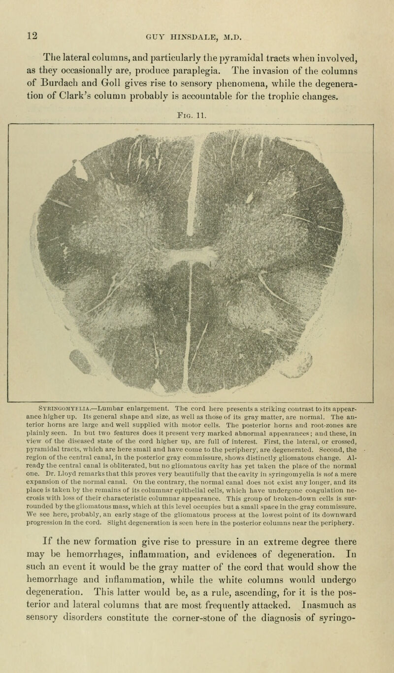 The lateral columns, and particularly the pyramidal tracts when involved, as they occasionally are, produce paraplegia. The invasion of the columns of Burdach and Goll gives rise to sensory phenomena, while the degenera- tion of Clark's column probably is accountable for the trophic changes. Fig. 11. Syringomyelia— Lumbar enlargement. The cord here presents a striking contrast to its appear- ance higher up. Its general shape and size, as well as those of its gray matter, are normal. The an- terior horns are large and well supplied with motor cells. The posterior horns and root-zones are plainly seen. In but two features does it present very marked abnormal appearances; and these, in view of the diseased state of the cord higher up, are full of interest. First, the lateral, or crossed, pyramidal tracts, which are here small and have come to the periphery, are degenerated. Second, the region of the central canal, in the posterior gray commissure, shows distinctly gliomatous change. Al- ready the central canal is obliterated, but no gliomatous cavity has yet taken the place of the normal one. Dr. Lloyd remarks that this proves very beautifully that the cavity in syringomyelia is not a mere expansion of the normal canal. On the contrary, the normal canal does not exist any longer, and its place is taken by the remains of its columnar epithelial cells, which have undergone coagulation ne- crosis with loss of their characteristic columnar appearance. This group of broken-down cells is sur- rounded by the gliomatous mass, which at this level occupies but a small space in the gray commissure. We see here, probably, an early stage of the gliomatous process at the lowest point of its downward progression in the cord. Slight degeneration is seen here in the posterior columns near the periphery. If the new formation give rise to pressure in an extreme degree there may be hemorrhages, inflammation, and evidences of degeneration. In such an event it would be the gray matter of the cord that would show the hemorrhage and inflammation, while the white columns would undergo degeneration. This latter would be, as a rule, ascending, for it is the pos- terior and lateral columns that are most frequently attacked. Inasmuch as sensory disorders constitute the corner-stone of the diagnosis of syringo-