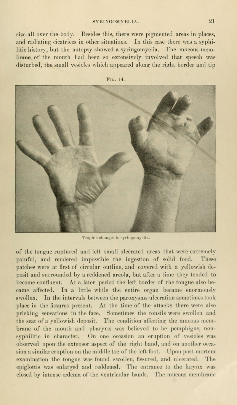 size all over the body. Besides this, there were pigmented areas in places, and radiating cicatrices in other situations. In this case there was a syphi- litic history, but the autopsy showed a syringomyelia. The mucous mem- brane of the mouth had been so extensively involved that speech was disturbed, the small vesicles which appeared along the right border and tip Fig. 14. Trophic changes in syringomyelia. of the tongue ruptured and left small ulcerated areas that were extremely painful, and rendered impossible the ingestion of solid food. These patches were at first of circular outline, and covered with a yellowish de- posit and surrounded by a reddened areola, but after a time they tended to become confluent. At a later period the left border of the tongue also be- came affected. In a little while the entire organ became enormously swollen. In the intervals between the paroxysms ulceration sometimes took place in the fissures present. At the time of the attacks there were also pricking sensations in the face. Sometimes the tonsils were swollen and the seat of a yellowish deposit. The condition affecting the mucous mem- brane of the mouth and pharynx was believed to be pemphigus, non- syphilitic in character. On one occasion an eruption of vesicles was observed upon the extensor aspect of the right hand, and on another occa- sion a similar eruption on the middle toe of the left foot. Upon post-mortem examination the tongue was found swollen, fissured, and ulcerated. The epiglottis was enlarged and reddened. The entrance to the larynx was closed by intense oedema of the ventricular bands. The mucous membrane