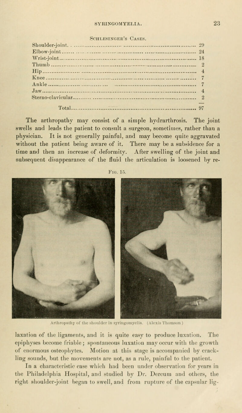 Schlesinger's Cases. Shoulder-joint 29 Elbow-joint 24 Wrist-joint 18 Thumb 2 Hip 4 Knee 7 Ankle 7 Jaw 4 Steruo-clavicular 2 Total 97 The arthropathy may consist of a simple hydrarthrosis. The joint swells and leads the patient to consult a surgeon, sometimes, rather thau a physician. It is not generally painful, and may become quite aggravated without the patient being aware of it. There may be a subsidence for a time and then an increase of deformity. After swelling of the joint and subsequent disappearance of the fluid the articulation is loosened by re- Fig. 15. Arthropathy of the shoulder in syringomyelia, I Alexis Thomson I taxation of the ligaments, and it is quite easy to produce luxation. The epiphyses become friable; spontaneous luxation may occur with the growth of enormous osteophytes. Motion at this stage is accompanied by crack- ling sounds, but the movements arc not, as a rule, painful to the patient. Tn a characteristic case which had been under observation for years in the Philadelphia Hospital, and studied by Dr. Dercum and others, the right shoulder-joint began to swell, and from rupture of the capsular lig-