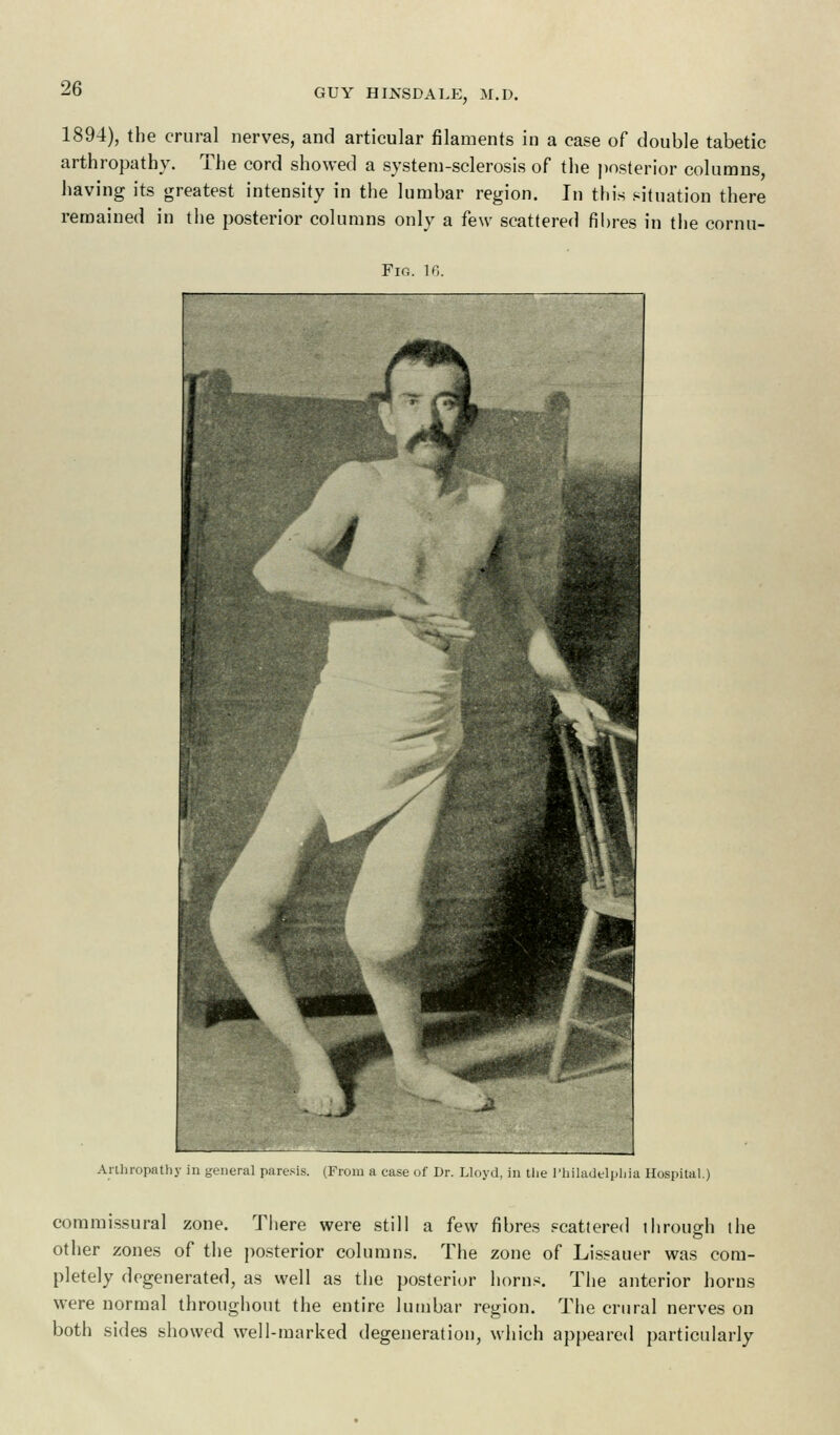 1894), the crural nerves, and articular filaments in a case of double tabetic arthropathy. The cord showed a system-sclerosis of the posterior columns, having its greatest intensity in the lumbar region. In this situation there remained in the posterior columns only a few scattered fibres in the cornu- Fir;. 16 Arthropathy in general paresis. (From a ease of Dr. Lloyd, in the Philadelphia Hospital.) commissural zone. There were still a few fibres scattered ihrough the other zones of the posterior columns. The zone of Lissauer was com- pletely degenerated, as well as the posterior horns. The anterior horns were normal throughout the entire lumbar region. The crural nerves on both sides showed well-marked degeneration, which appeared particularly