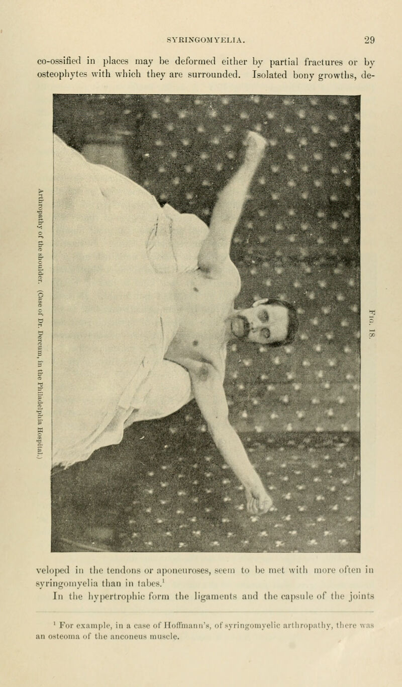 co-ossified in places may be deformed either by partial fractures or by osteophytes with which they are surrounded. Isolated bony growths, de- veloped in the tendons or aponeuroses, seem to be met with more often in syringomyelia than in tabes.1 In the hypertrophic form the ligaments and the capsule of the joints 1 For example, in a ease of 11 oilman n's, of syringomyelic arthropathy, there was an osteoma of the anconeus mu