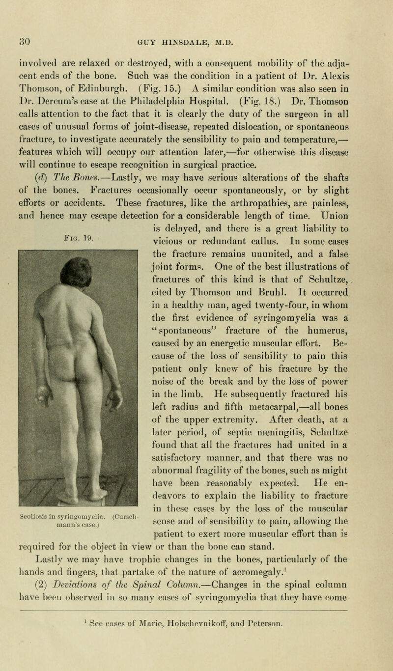 Fir;. 19. involved are relaxed or destroyed, with a consequent mobility of the adja- cent ends of the bone. Such was the condition in a patient of Dr. Alexis Thomson, of Edinburgh. (Fig. ]5.) A similar condition was also seen in Dr. Dercum's case at the Philadelphia Hospital. (Fig. 18.) Dr. Thomson calls attention to the fact that it is clearly the duty of the surgeon in all cases of unusual forms of joint-disease, repeated dislocation, or spontaneous fracture, to investigate accurately the sensibility to pain and temperature,— features which will occupy our attention later,—for otherwise this disease will continue to escape recognition in surgical practice. (d) The Bones.—Lastly, we may have serious alterations of the shafts of the bones. Fractures occasionally occur spontaneously, or by slight efforts or accidents. These fractures, like the arthropathies, are painless, and hence may escape detection for a considerable length of time. Union is delayed, and there is a great liability to vicious or redundant callus. In some cases the fracture remains ununited, and a false joint forms. One of the best illustrations of fractures of this kind is that of Schultze,. cited by Thomson and Bruhl. It occurred in a healthy man, aged twenty-four, in whom the first evidence of syringomyelia was a spontaneous fracture of the humerus, caused by an energetic muscular effort. Be- cause of the loss of sensibility to pain this patient only knew of his fracture by the noise of the break and by the loss of power in the limb. He subsequently fractured his left radius and fifth metacarpal,—all bones of the upper extremity. After death, at a later period, of septic meningitis, Schultze found that all the fractures had united in a satisfactory manner, and that there was no abnormal fragility of the bones, such as might have been reasonably expected. He en- deavors to explain the liability to fracture in these cases by the loss of the muscular sense and of sensibility to pain, allowiug the patient to exert more muscular effort than is required for the object in view or than the bone can stand. Lastly we may have trophic changes in the bones, particularly of the hands and fingers, that partake of the nature of acromegaly.1 (2) Deviations of the Spinal Column.—Changes in the spinal column have been observed in so many cases of syringomyelia that they have come Scoliosis in syringomyelia. (Cursch mann's case.) 1 See cases of Marie, Holsckevnikoff, and Peterson.