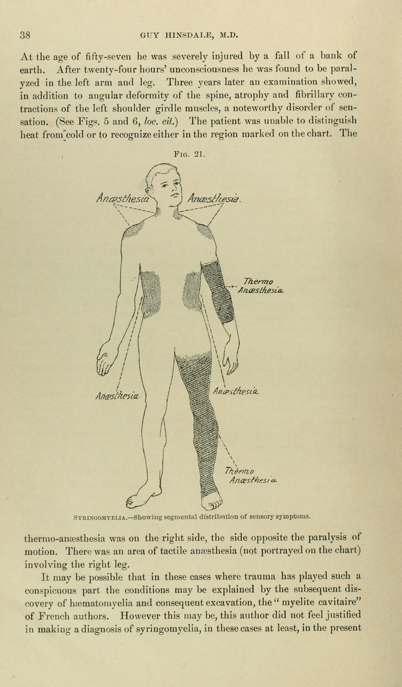 At the age of fifty-seven he was severely injured by a fall of a bank of earth. After twenty-four hours' unconsciousness he was found to be paral- yzed in the left arm and leg. Three years later an examination showed, in addition to angular deformity of the spine, atrophy and fibrillary con- tractions of the left shoulder girdle muscles, a noteworthy disorder of sen- sation. (See Figs. 5 and 6, loc. cit.) The patient was unable to distinguish heat fronfcold or to recognize either in the region marked on the chart. The Fig. 21. Aricsst/iesta Thermo Ancestkesca. Aricpsthesca. T/zer/nc Syringomyelia.—Showing segmental distribution of sensory symptoms. thermo-amesthesia was on the right side, the side opposite the paralysis of motion. There was an area of tactile anaesthesia (not portrayed on the chart) involving the right leg. It may be possible that in these cases where trauma has played such a conspicuous part the conditions may be explained by the subsequent dis- covery of hsematomyelia and consequent excavation, the myelite cavitaire of French authors. However this may be, this author did not feel justified in making a diagnosis of syringomyelia, in these cases at least, in the present