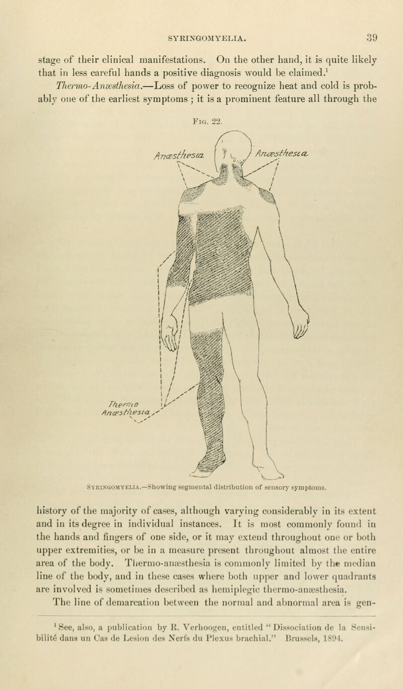 stage of their clinical manifestations. On the other hand, it is quite likely that in less careful hands a positive diagnosis would be claimed.1 Thermo-Ansesthesia.—Loss of power to recognize heat and cold is prob- ably one of the earliest symptoms ; it is a prominent feature all through the Fig. 22. Ancesthesca Anesthesia. Thermo Ancesh'iestci. Syringomyelia.—Showing segmental distribution of sensory symptoms. history of the majority of cases, although varying considerably in its extent and in its degree in individual instances. It is most commonly found in the hands and fingers of one side, or it may extend throughout one or both upper extremities, or be in a measure present throughout almost the entire area of the body. Thermo-ansesthesia is commonly limited by the median line of the body, and in these cases where both upper and lower quadrants are involved is sometimes described as hemiplegic thermo-ansesthesia. The line of demarcation between the normal and abnormal area is gen- 1 See, also, u publication by R. Verhoogen, entitled  Dissociation de la Sensi- bility dans un Cas de Lesion des Nerfs du Plexus brachial. Brussels, L894.