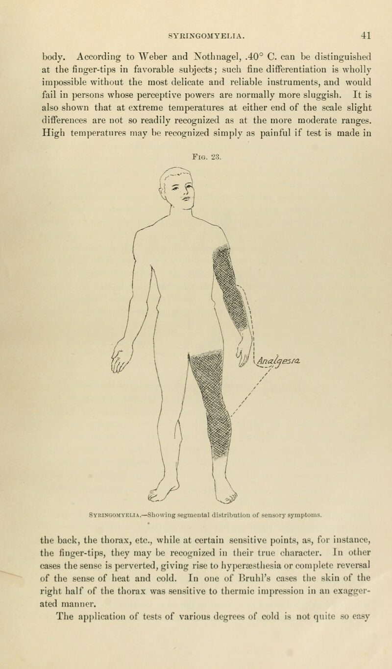 body. According to Weber and Nothnagel, .40° C. can be distinguished at the finger-tips in favorable subjects; such fine differentiation is wholly impossible without the most delicate and reliable instruments, and would fail in persons whose perceptive powers are normally more sluggish. It is also shown that at extreme temperatures at either end of the scale slight differences are not so readily recognized as at the more moderate ranges. High temperatures may be recognized simply as painful if test is made in Fig. 23. yjt \Analge5fa. Syringomyelia.—Showing segmental distribution of sensory symptoms. the back, the thorax, etc., while at certain sensitive points, as, for instance, the finger-tips, they may be recognized in their true character. In other cases the sense is perverted, giving rise to hyperesthesia or complete reversal of the sense of heat and cold. In one of Bruhl's cases the skin of the right half of the thorax was sensitive to thermic impression in an exagger- ated manner. The application of tests of various degrees of cold is not quite so easy