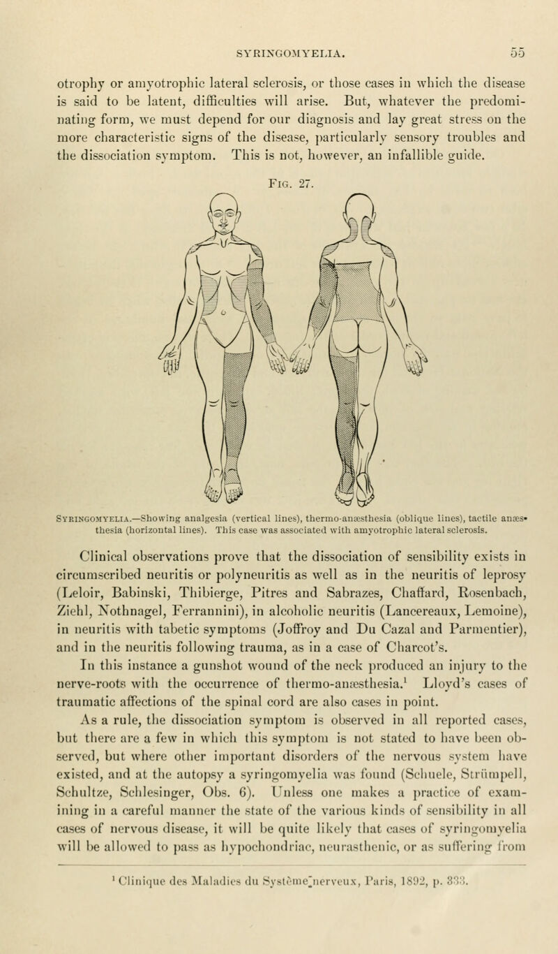 otrophy or amyotrophic lateral sclerosis, or those cases in which the disease is said to be latent, difficulties will arise. But, whatever the predomi- nating form, we must depend for our diagnosis and lay great stress on the more characteristic signs of the disease, particularly sensory troubles and the dissociation symptom. This is not, however, an infallible guide. Fig. 27. Syringomyelia.—Showing analgesia (vertical lines), thermoanesthesia (oblique lines), tactile anses* thesia (horizontal lines). This case was associated with amyotrophic lateral sclerosis. Clinical observations prove that the dissociation of sensibility exists in circumscribed neuritis or polyneuritis as well as in the neuritis of leprosy (Leloir, Babinski, Thibierge, Pitres and Sabrazes, ChafTard, Rosenbach, Ziehl, Nothnagel, Ferrannini), in alcoholic neuritis (Lancereaux, Lemoine), in neuritis with tabetic symptoms (Joffroy and Du Cazal and Parmentier), and in the neuritis following trauma, as in a case of Charcot's. In this instance a gunshot wound of the neck produced an injury to the nerve-roots with the occurrence of thermo-ainesthesia.1 Lloyd's cases of traumatic affections of the spinal cord are also cases in point. As a rule, the dissociation symptom is observed in all reported cases, but there are a few in which this symptom is not stated to have been ob- served, but where other important disorders of the nervous system have existed, and at the autopsy a syringomyelia was found (Schuele, Striimpell, Schultze, Schlesinger, Obs. 6). Unless one makes a practice of exam- ining in a careful manner the state of the various kinds of sensibility in all cases of nervous disease, it will be quite likely that cases of syringomyelia will be allowed to pass as hypochondriac, neurasthenic, or as suffering from 1 Clinique des Maladies du Systeme'nerveux, Paris, 1892, p,