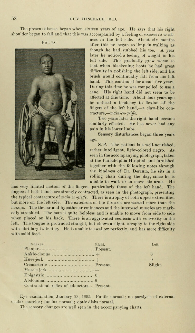 Fig. 28. The present disease began when sixteen years of age. He says that his right shoulder began to fall and that this was accompanied by a feeling of excessive weak- ness in the left side. About six months after this he began to limp in walking as though he had stubbed his toe. A year later he noticed a feeling of weight in his left side. This gradually grew worse so that when blackening boots he had great difficulty in polishing the left side, and his brush would continually fall from his left hand. This continued for about five years. During this time he was compelled to use a cane. His right hand did not seem to be affected at this time. About four years ago he noticed a tendency to flexion of the fingers of the left hand,—a claw-like con- tracture,—main-en -griffe. Two years later the right hand became similarly effected. He has never had any pain in his lower limbs. Sensory disturbances began three years ago. S. P.—The patient is a well-nourished, rather intelligent, light-colored negro. As seen in the accompanying photograph, taken at the Philadelphia Hospital, and furnished together with the following notes through the kindness of Dr. Dercum, he sits in a rolling chair during the day, since he is unable to walk or to move his arms. He has very limited motion of the fingers, particularly those of the left hand. The fingers of both hands are strongly contracted, as seen in the photograph, presenting the typical contracture of main-en-griffe. There is atrophy of both upper extremities, but more on the left side. The extensors of the forearm are wasted more than the flexors. The thenar and hypothenar eminences and the interossei muscles are mark- edly atrophied. The man is quite helpless and is unable to move from side to side when placed on his back. There is an aggravated scoliosis with convexity to the left. The tongue is protruded straight, but shows a slight atrophy to the right side with fibrillary twitching. He is unable to swallow perfectly, and has more difficulty with solid food. Reflexes. Right. Plantar Present. Ankle-clonus -f Knee-jerk -j- Cremasteric Present. Muscle-jerk -f- Epigastric 0 Abdominal 0 Contralateral reflex of adductors.... Present. Left. 0 0 Slight. Eye examination, January 23, 1895. Pupils normal; no paralysis of external ocular muscles; fundus normal; optic disks normal. The sensory changes are well seen in the accompanying charts.