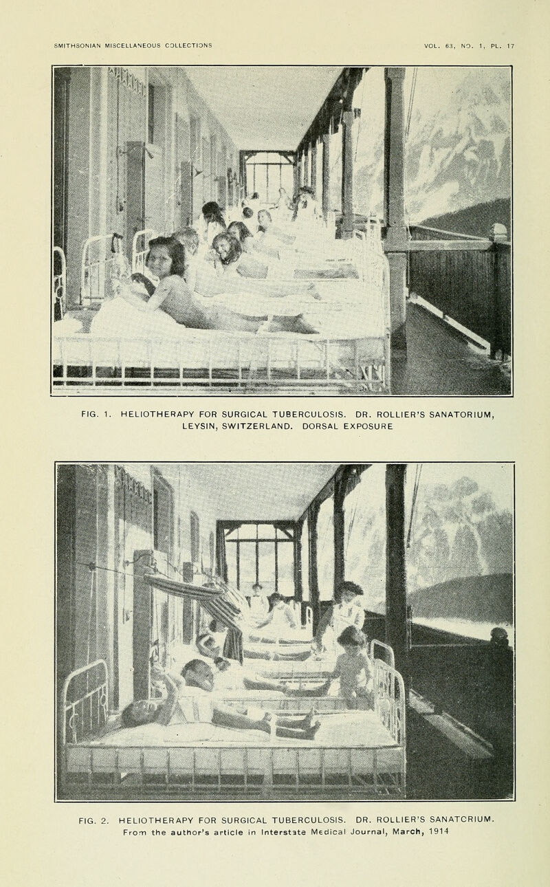 liii»Kaa FIG. 1. HELIOTHERAPY FOR SURGICAL TUBERCULOSIS. DR. ROLLIER'S SANATORIUM, LEYSIN, SWITZERLAND. DORSAL EXPOSURE FIG. 2. HELIOTHERAPY FOR SURGICAL TUBERCULOSIS. DR. ROLLIER'S SANATORIUM. From the author's article in Interstate Medical Journal, March, 1914