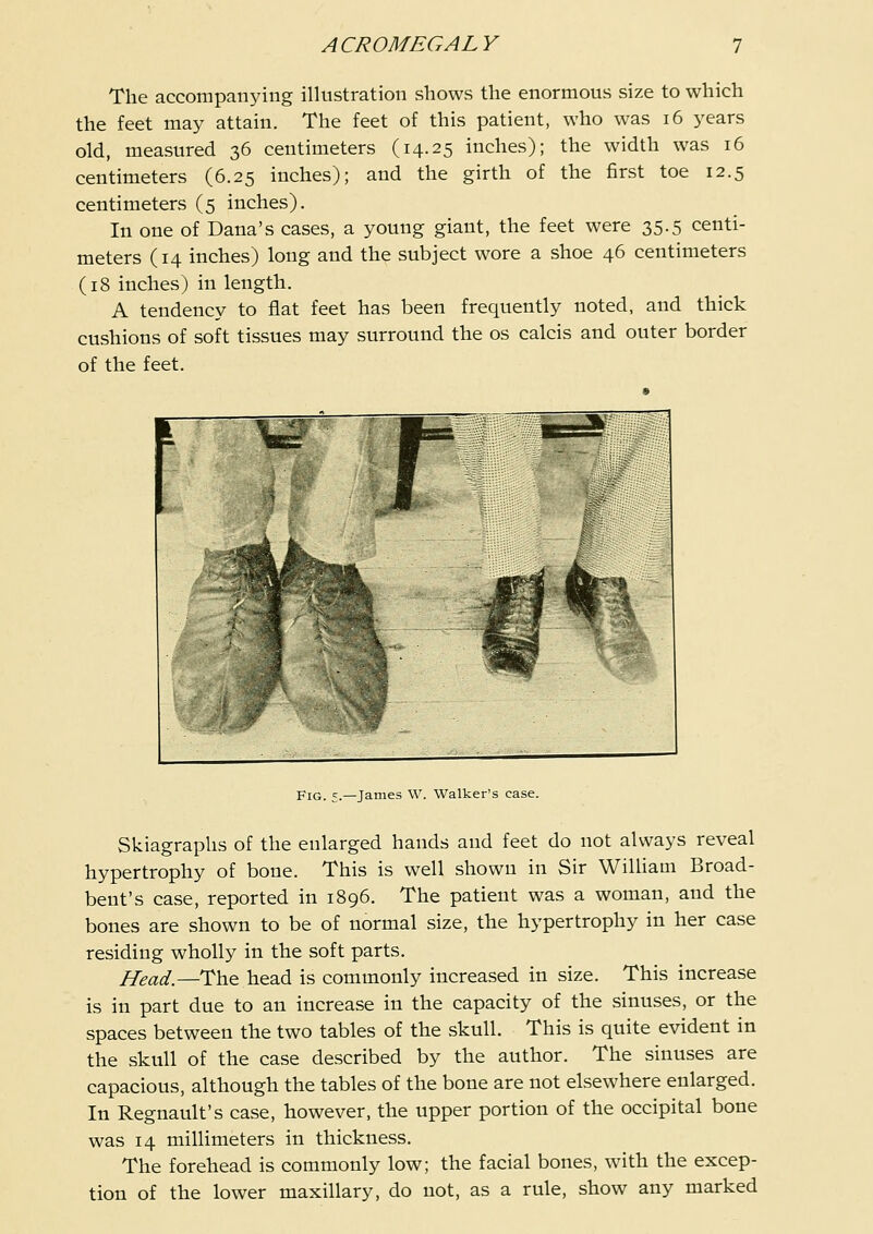 The accompanying illustration shows the enormous size to which the feet may attain. The feet of this patient, who was i6 years old, measured 36 centimeters (14.25 inches); the width was 16 centimeters (6.25 inches); and the girth of the first toe 12.5 centimeters (5 inches). In one of Dana's cases, a young giant, the feet were 35.5 centi- meters (14 inches) long and the subject wore a shoe 46 centimeters (18 inches) in length. A tendency to fiat feet has been frequently noted, and thick cushions of soft tissues may surround the os calcis and outer border of the feet. Fig. 5.—James W. Walker's case. Skiagraphs of the enlarged hands and feet do not always reveal hypertrophy of bone. This is well shown in Sir WiUiam Broad- bent's case, reported in 1896. The patient was a woman, and the bones are shown to be of normal size, the hypertrophy in her case residing wholly in the soft parts. Head.—The head is commonly increased in size. This increase is in part due to an increase in the capacity of the sinuses, or the spaces between the two tables of the skull. This is quite evident in the skull of the case described by the author. The sinuses are capacious, although the tables of the bone are not elsewhere enlarged. In Regnault's case, however, the upper portion of the occipital bone was 14 millimeters in thickness. The forehead is commonly low; the facial bones, with the excep- tion of the lower maxillary, do not, as a rule, show any marked