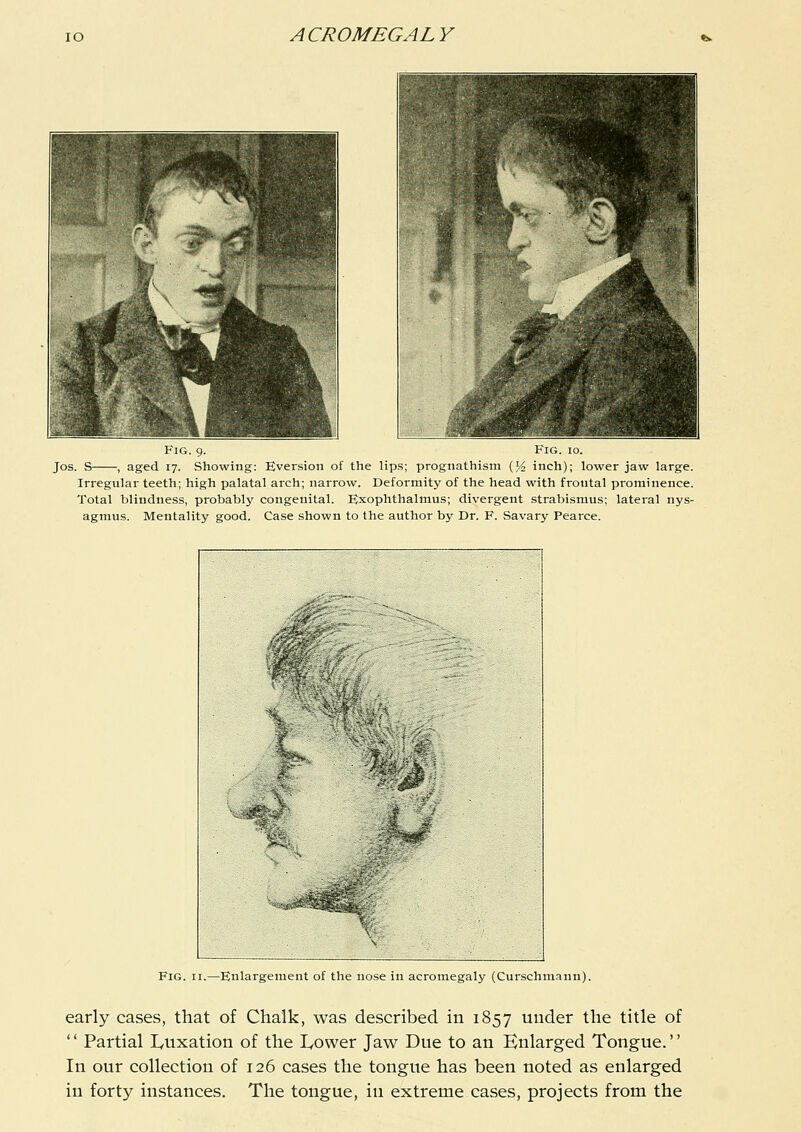 Fig. 9. Fig. 10. Jos. S , aged 17. Showing: Eversion of the lips; prognathism (5^ inch); lower jaw large. Irregular teeth; high palatal arch; narrow. Deformity of the head with frontal prominence. Total blindness, probably congenital. Exophthalmus; divergent strabismus; lateral nys- agmus. Mentality good. Case shown to the author by Dr. F. Savary Pearce. Fig. II.—Enlargement of the nose in acromegaly (Curschmann). early cases, that of Chalk, was described in 1857 under the title of  Partial lyuxation of the I^ower Jaw Due to an Enlarged Tongue. In our collection of 126 cases the tongue has been noted as enlarged in forty instances. The tongue, in extreme cases, projects from the